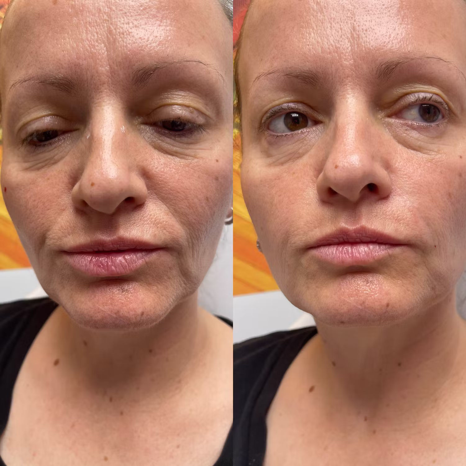 Dermal filler before and after result