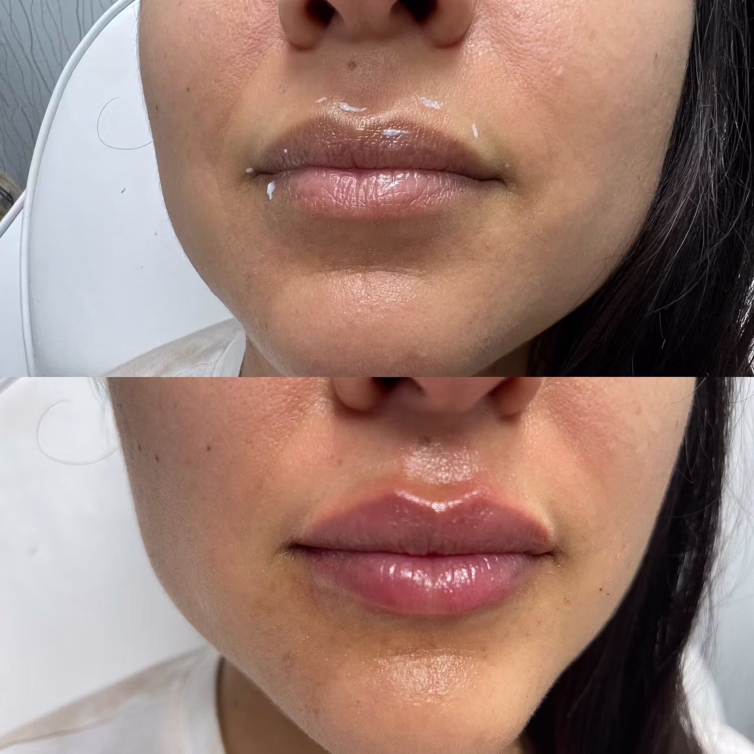 Dermal filler before and after result