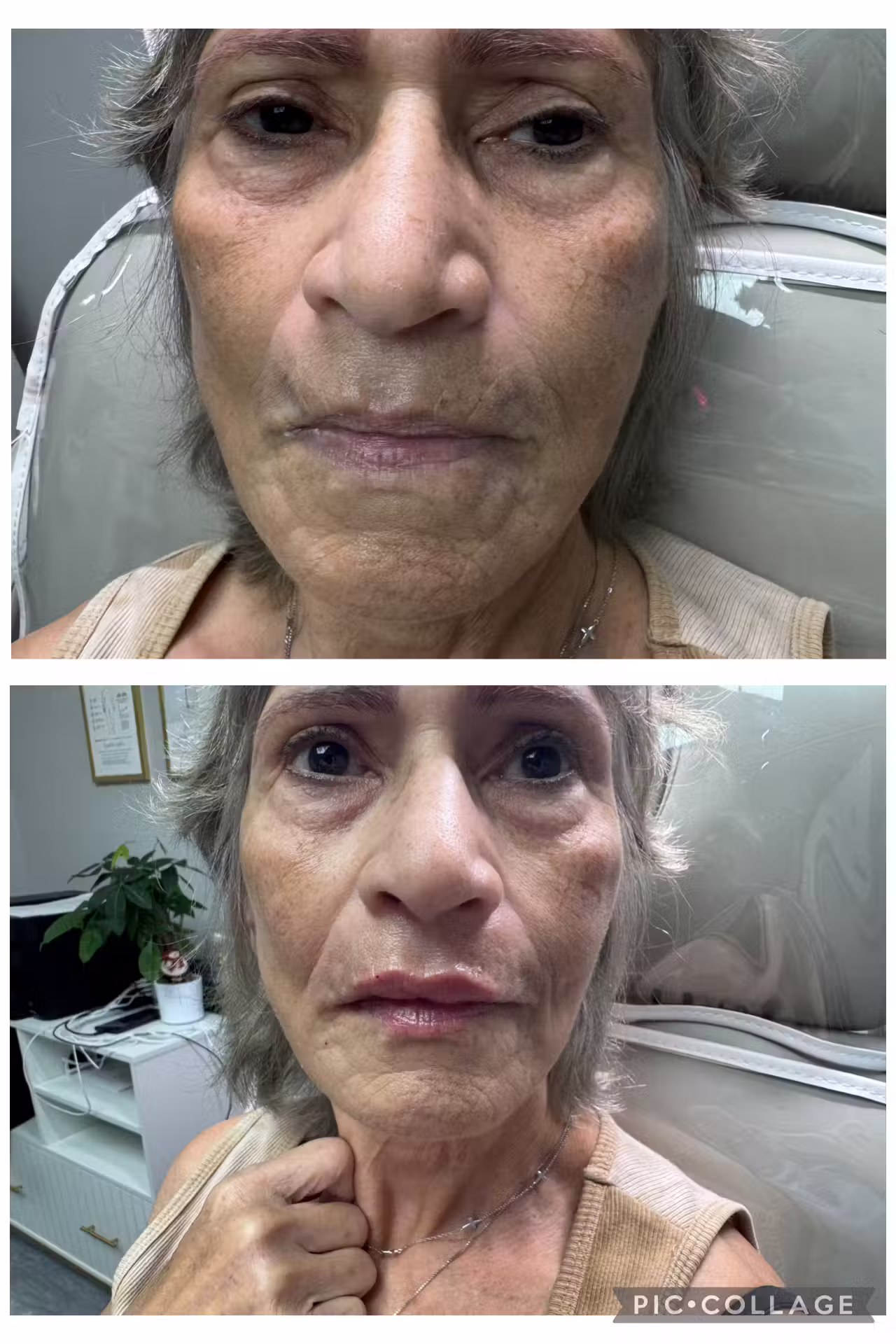 Dermal filler before and after result