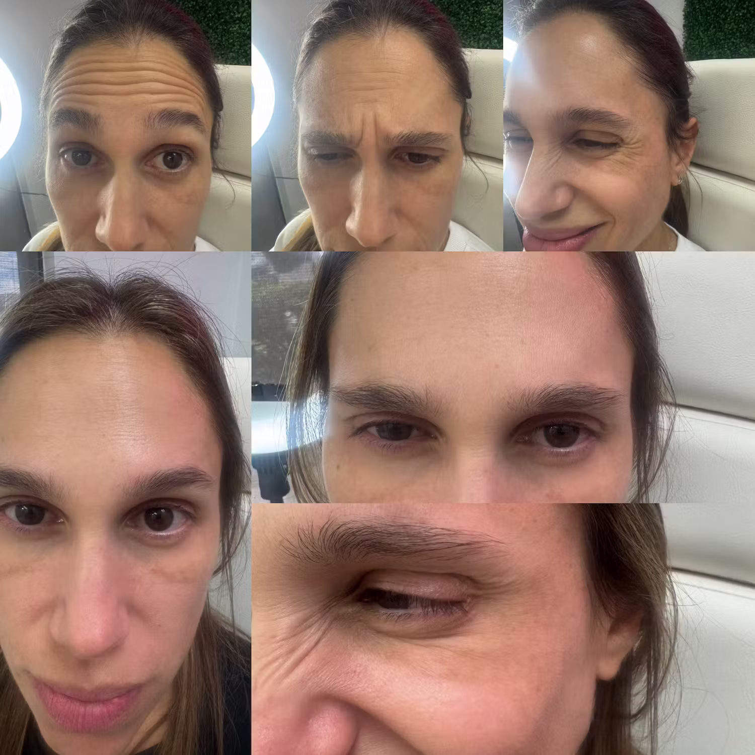 Botox before and after result