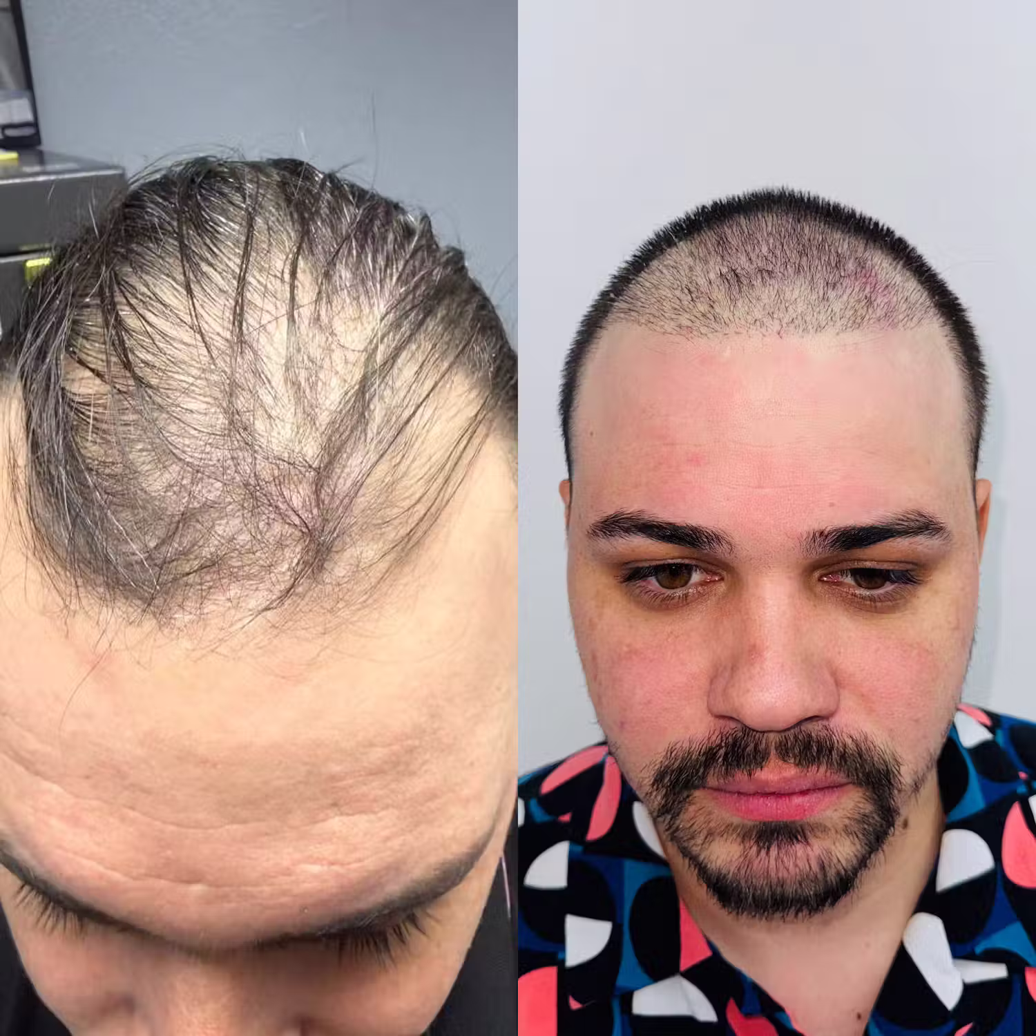FUE hair transplant before and after result