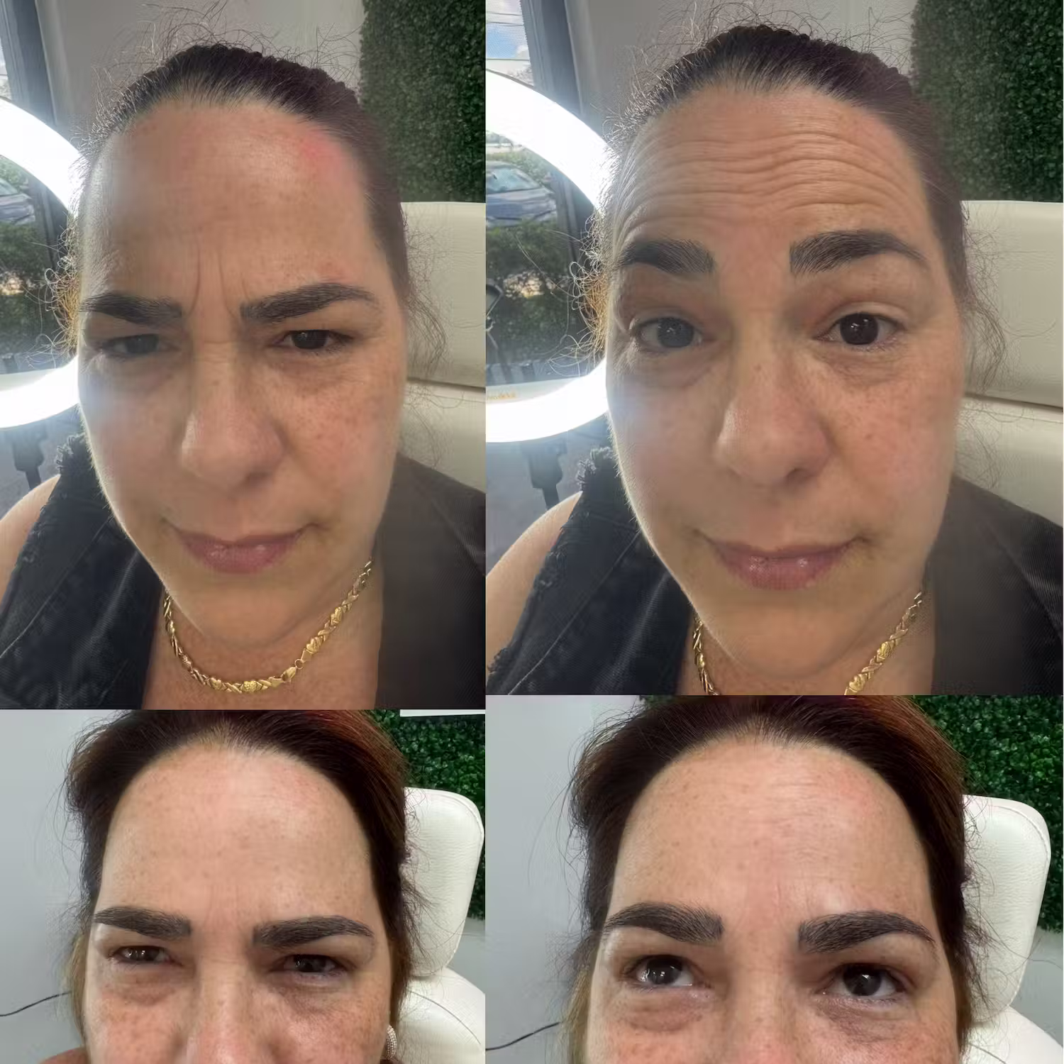 Botox before and after result