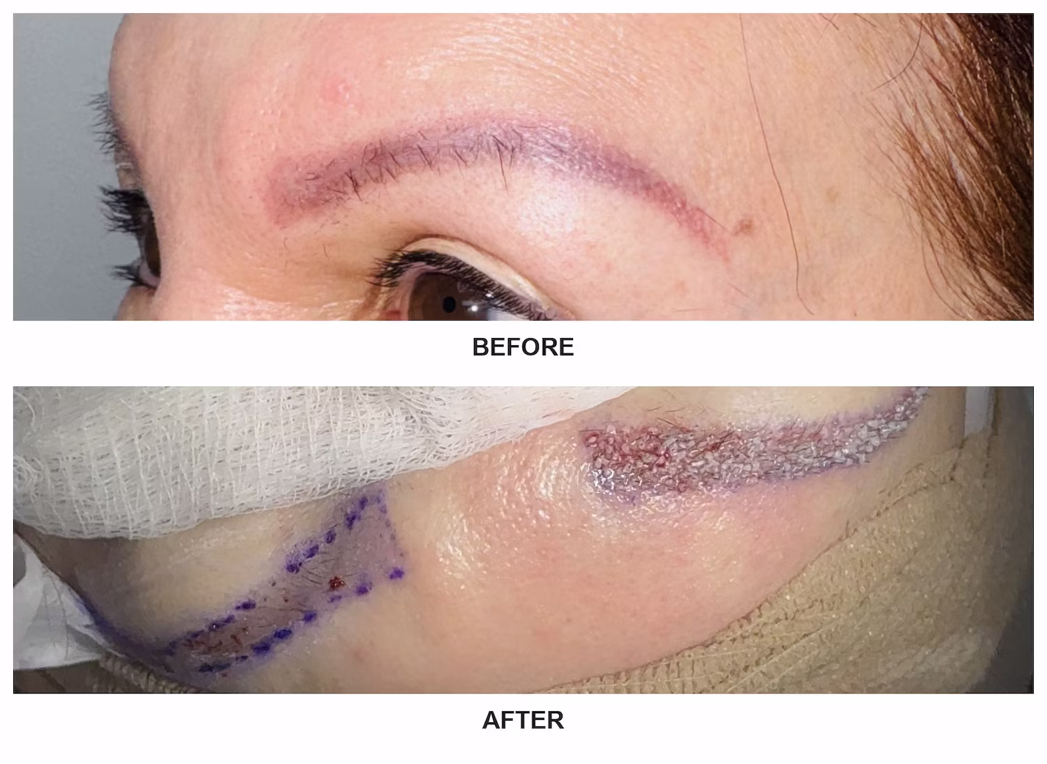 FUE eyebrow transplant before and after result