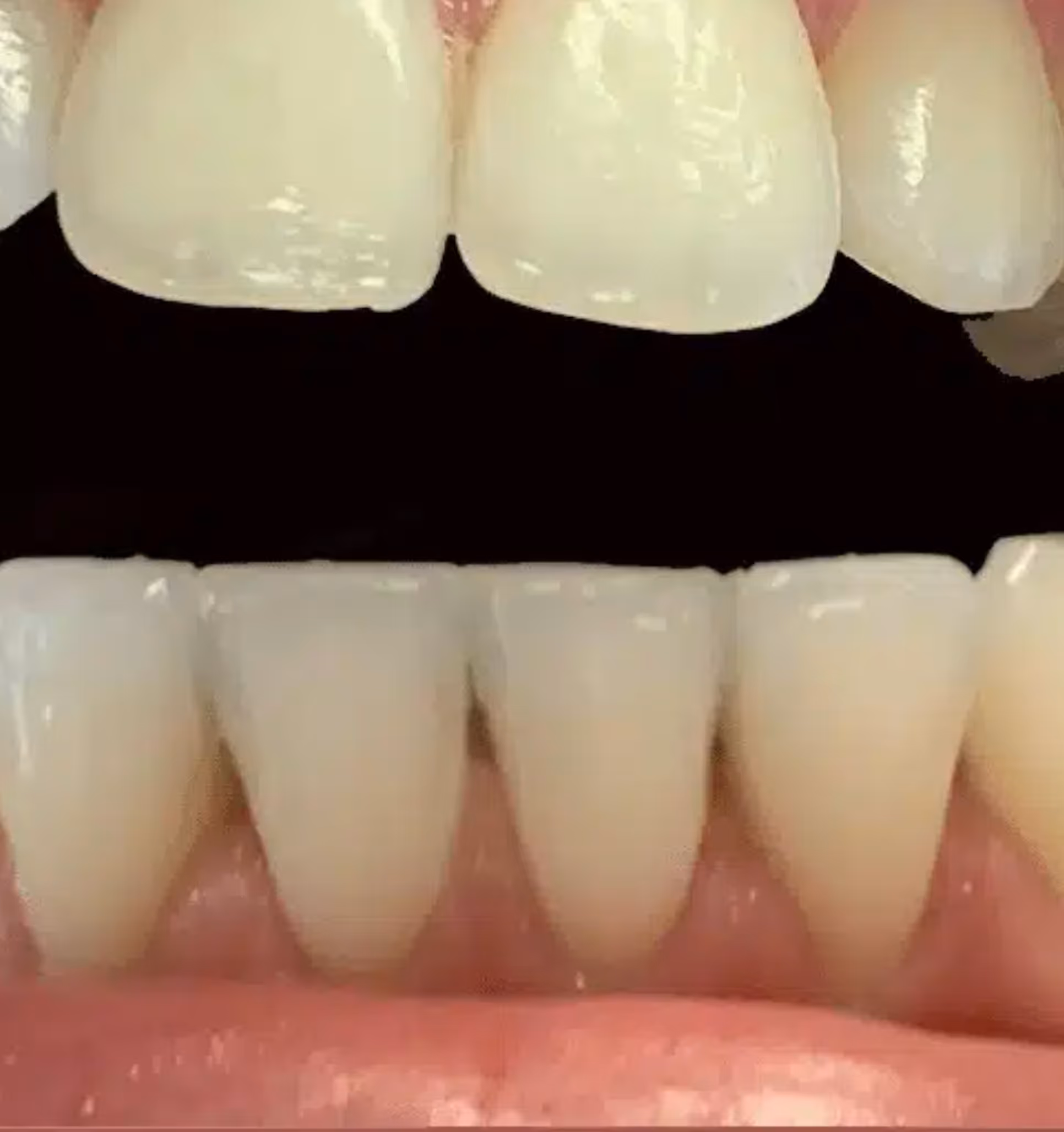 Close-up of upper and lower human teeth and gums with mouth open.