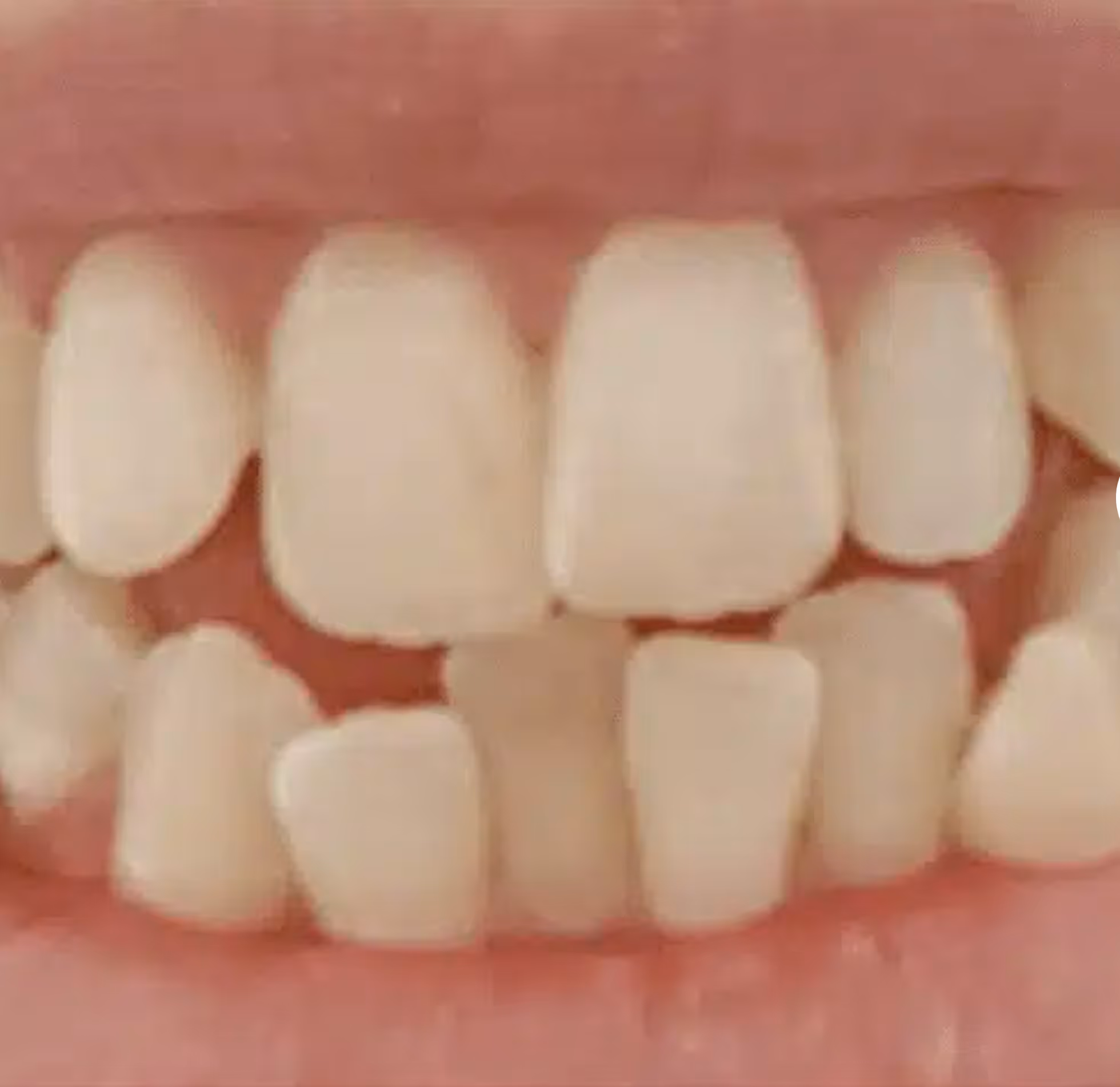 Close-up of human teeth with noticeable discoloration on one lower front tooth.