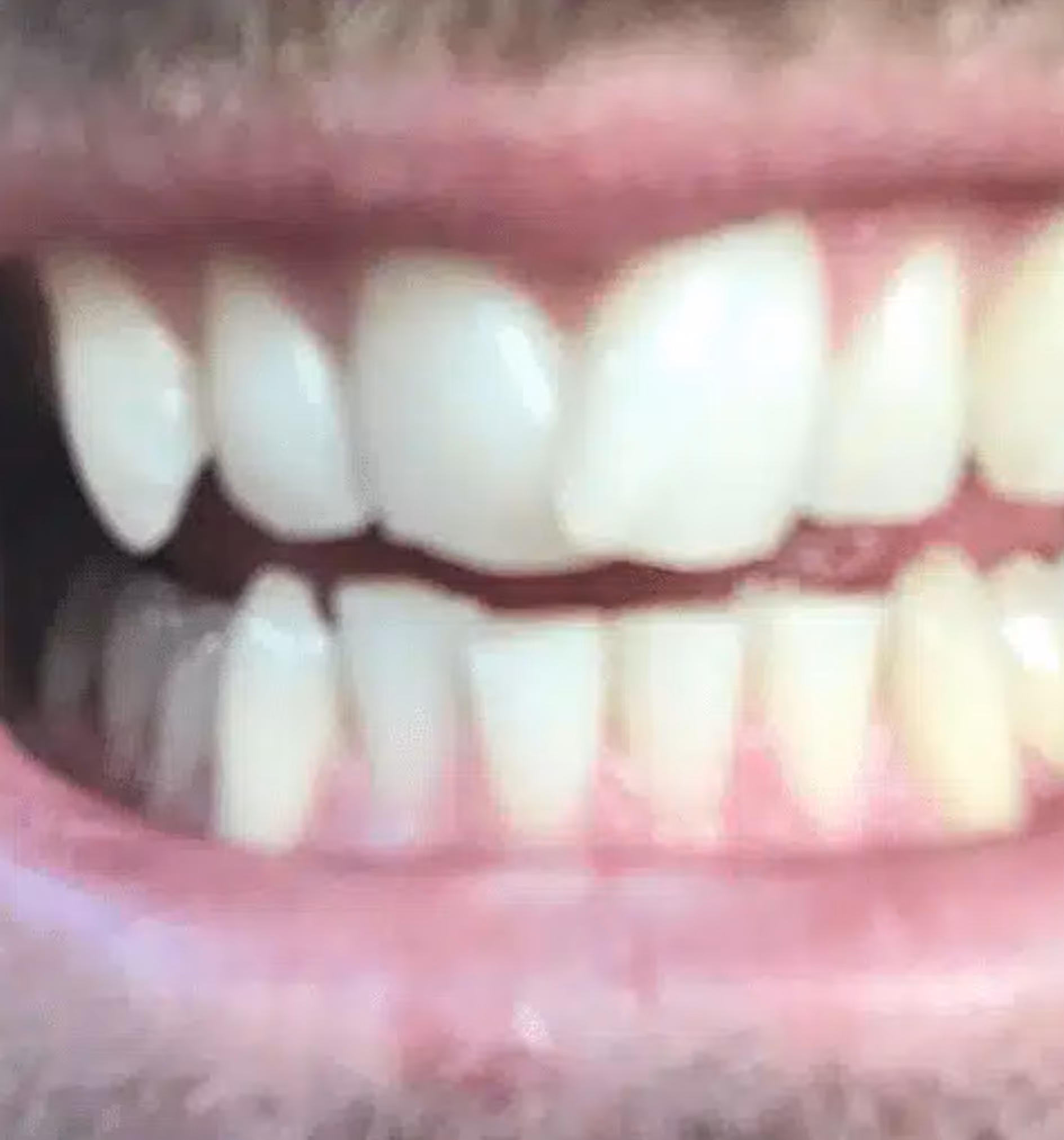 Close-up of a smiling mouth showing upper and lower teeth with visible gaps.
