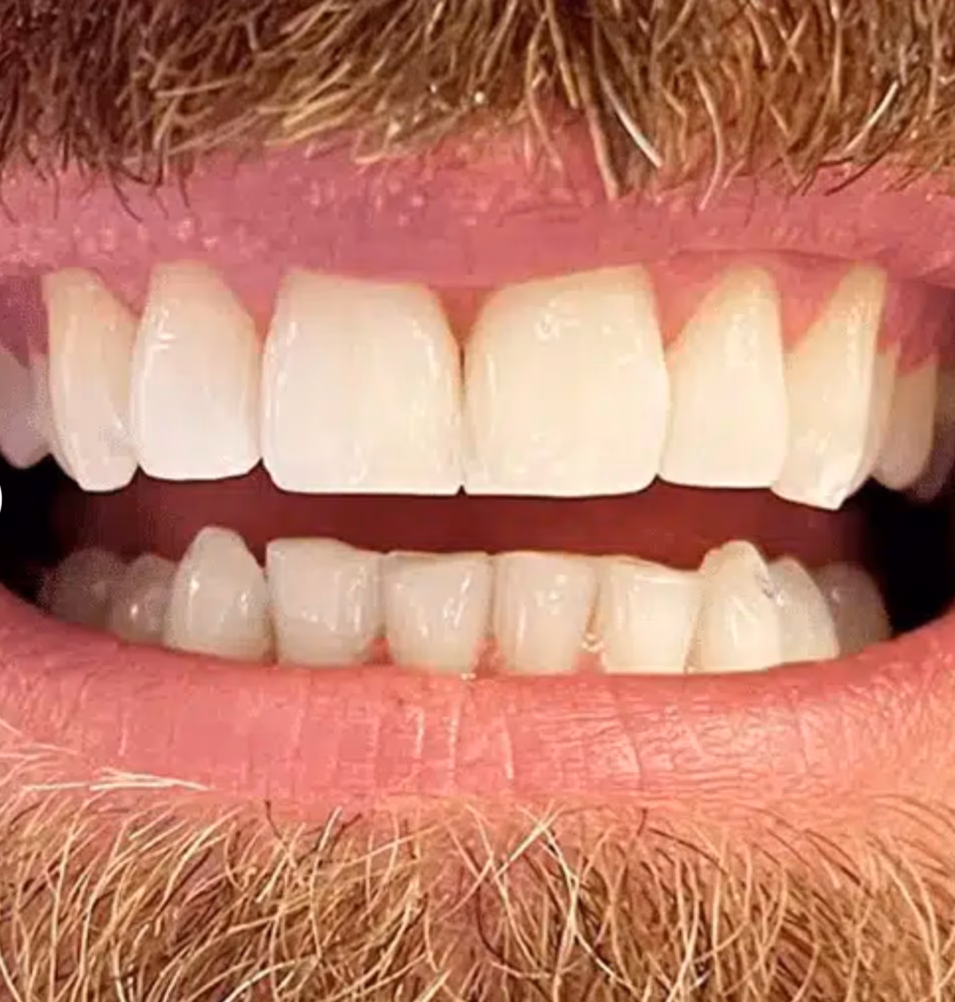 Close-up of a man's mouth with lips, mustache, and visible upper and lower teeth.