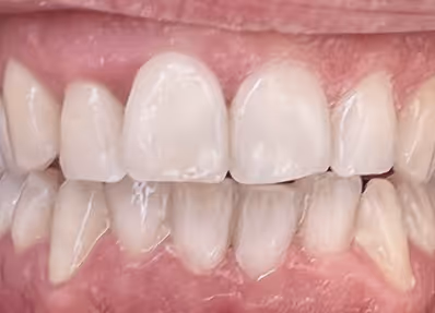 Close-up of a person's mouth showing upper and lower teeth and gums.
