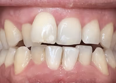 Close-up of uneven, slightly spaced upper and lower front teeth with visible gaps and irregular alignment.