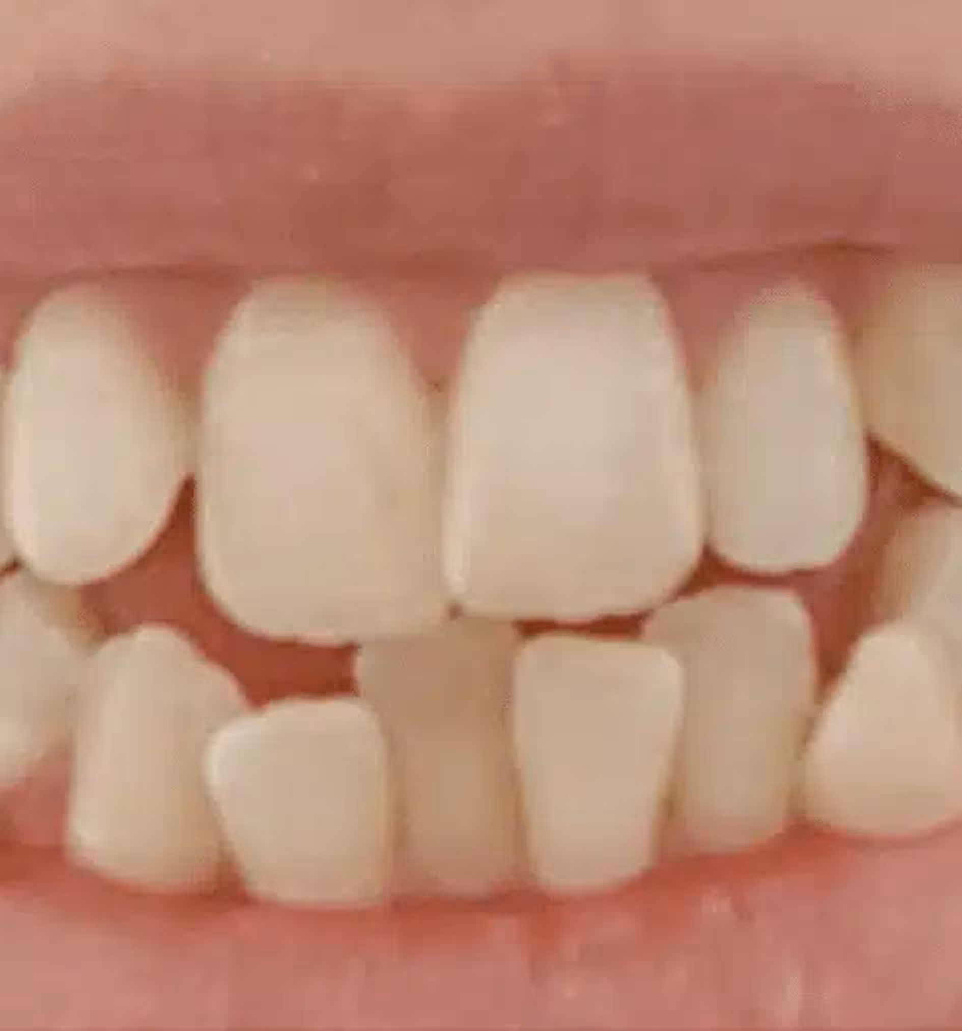 Close-up of teeth with significant gaps between upper and lower front teeth.
