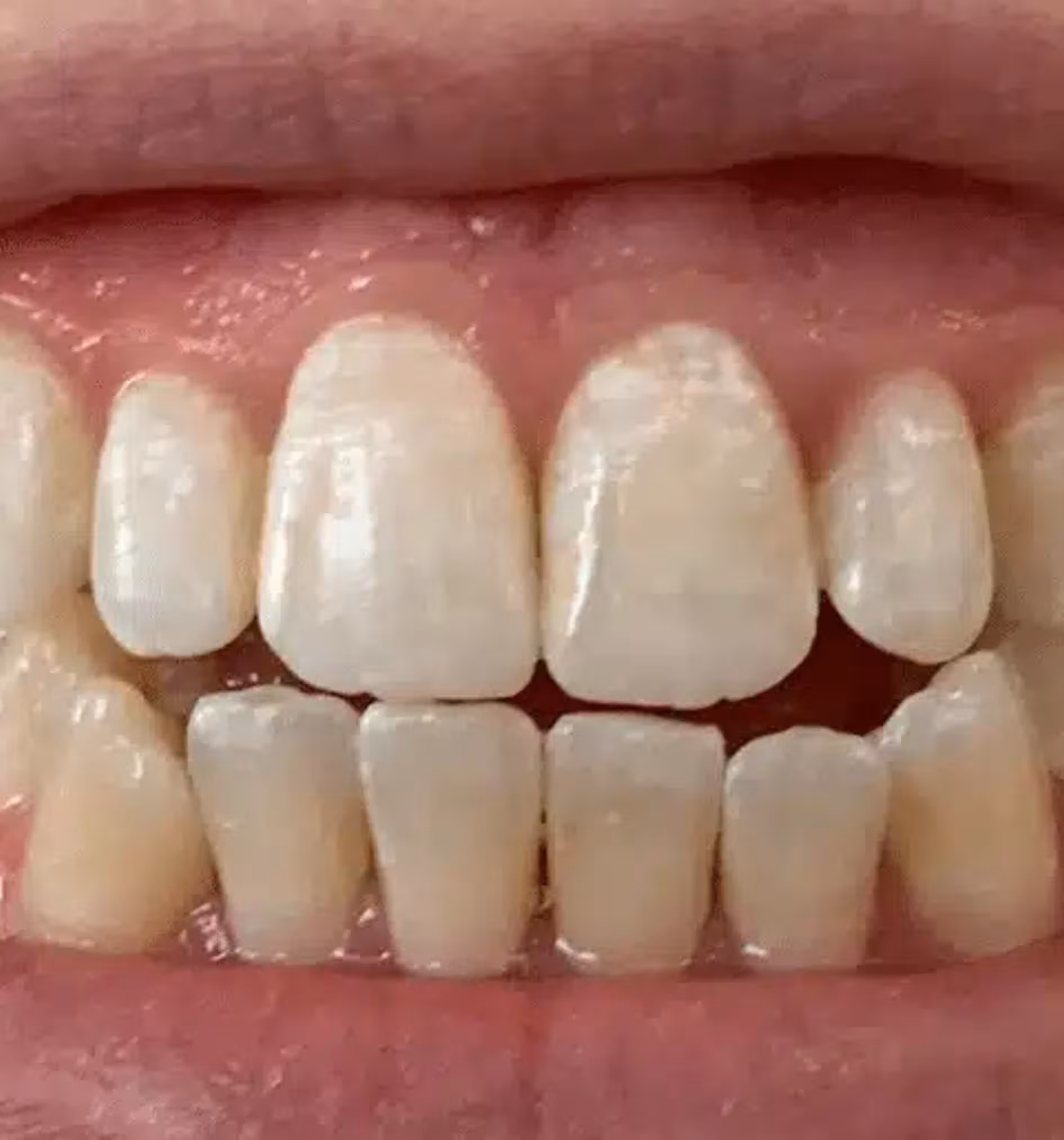 Close-up of upper and lower teeth showing uneven edges and slight gaps between them.