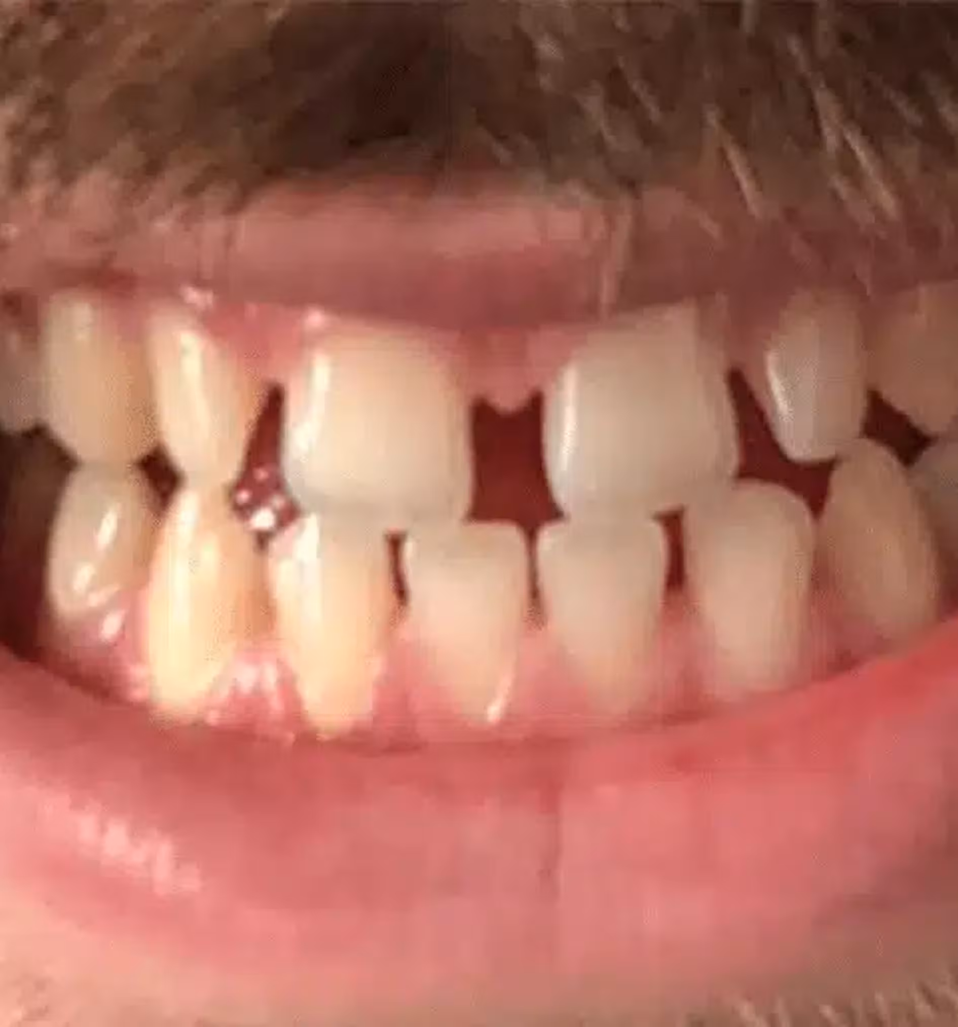 Close-up of an open mouth showing uneven teeth with gaps and missing front teeth.