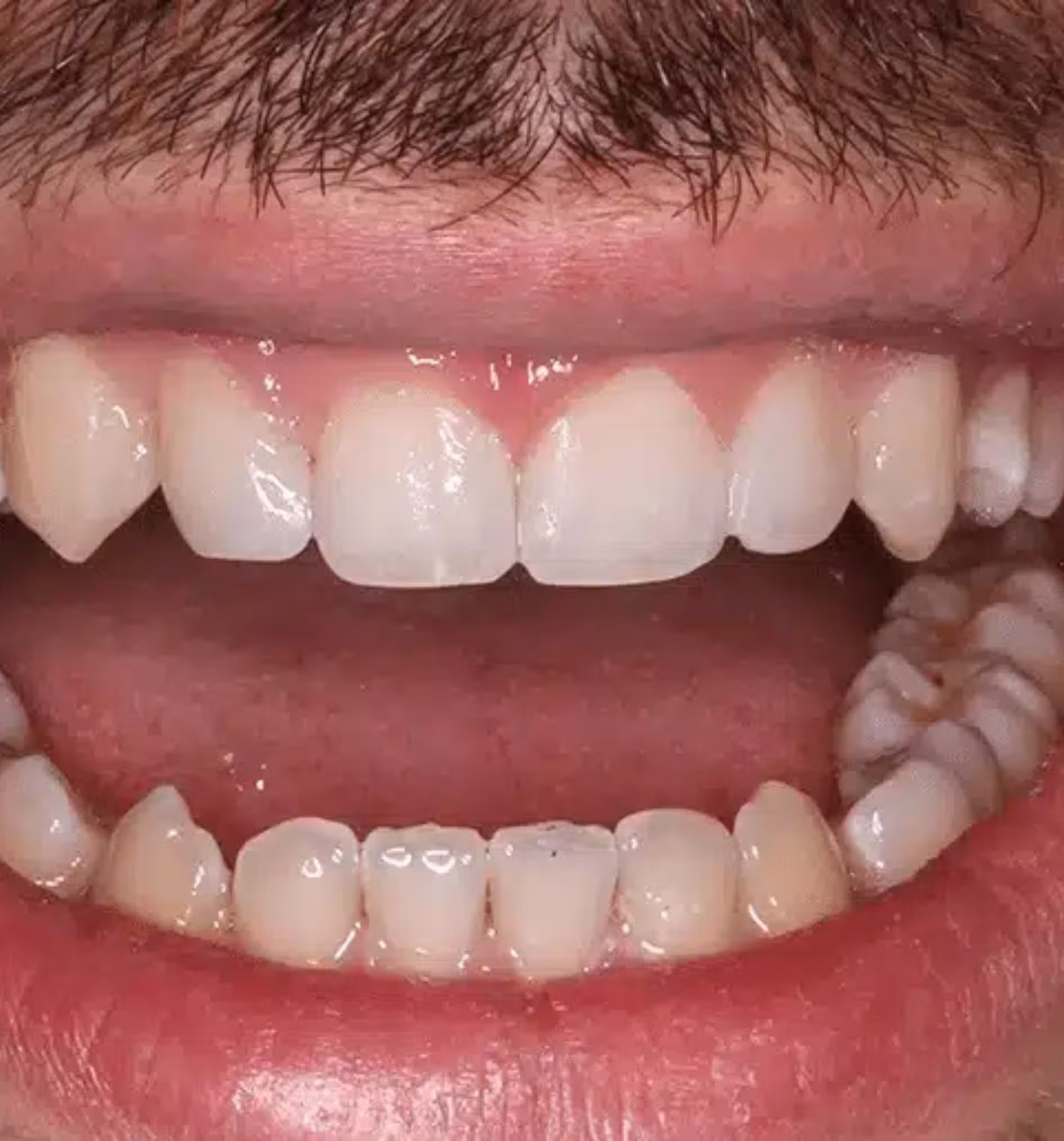 Close-up of an open mouth showing upper and lower teeth with visible gums and lips.