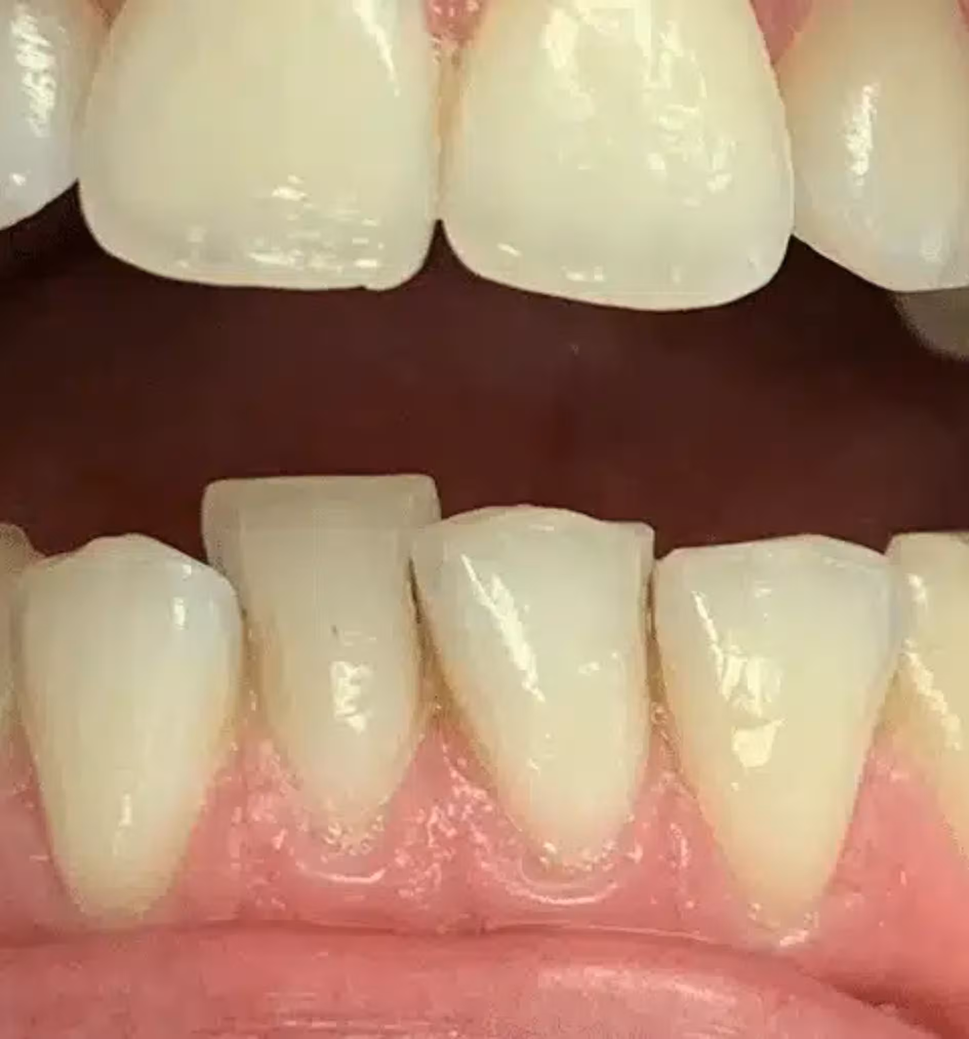 Close-up of lower front teeth with one tooth significantly shorter and worn down.