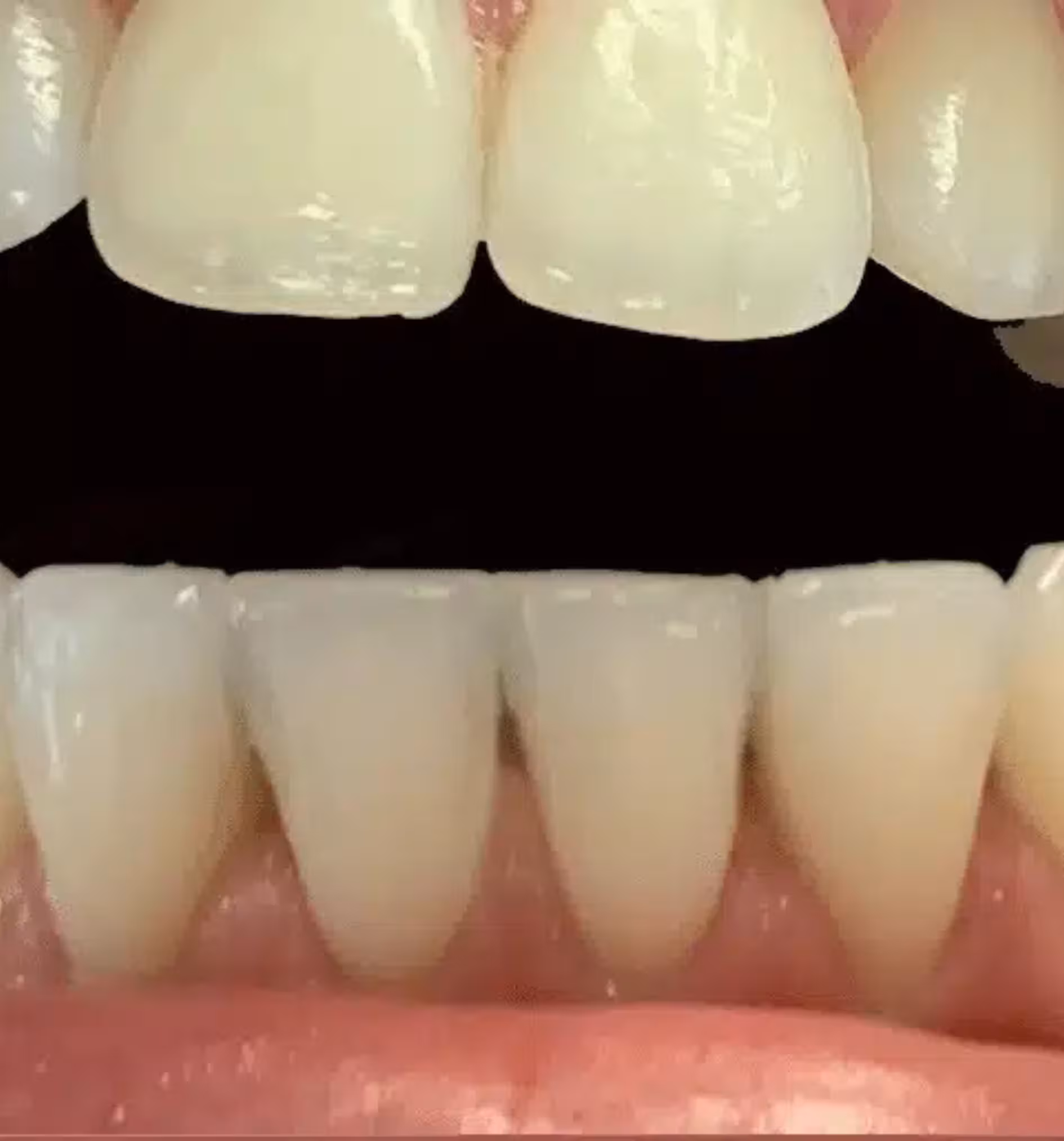 Close-up of upper and lower front teeth showing clean white teeth and healthy gums.