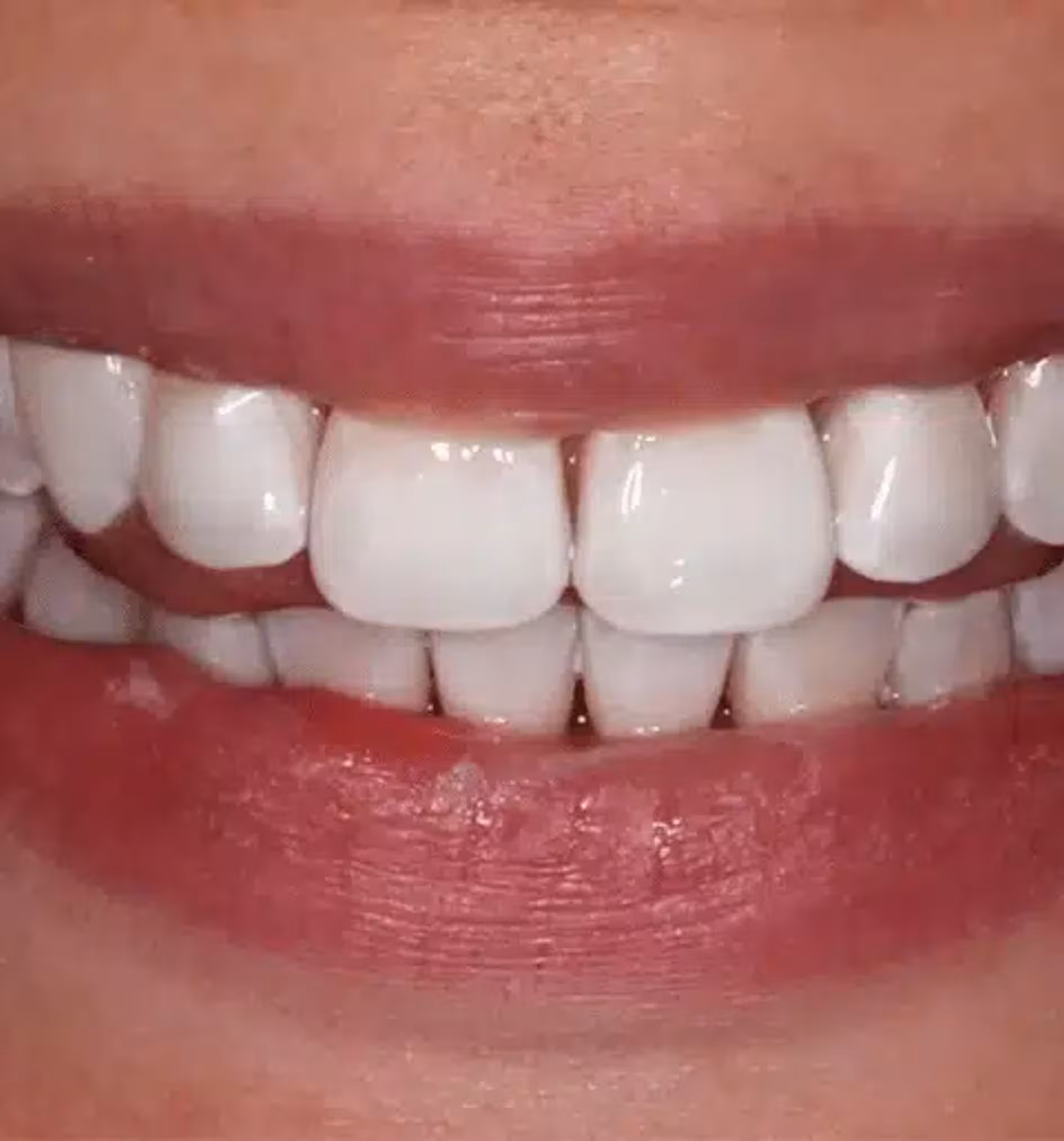 Close-up of a person's mouth showing clean, white, neatly aligned teeth with lips slightly parted.
