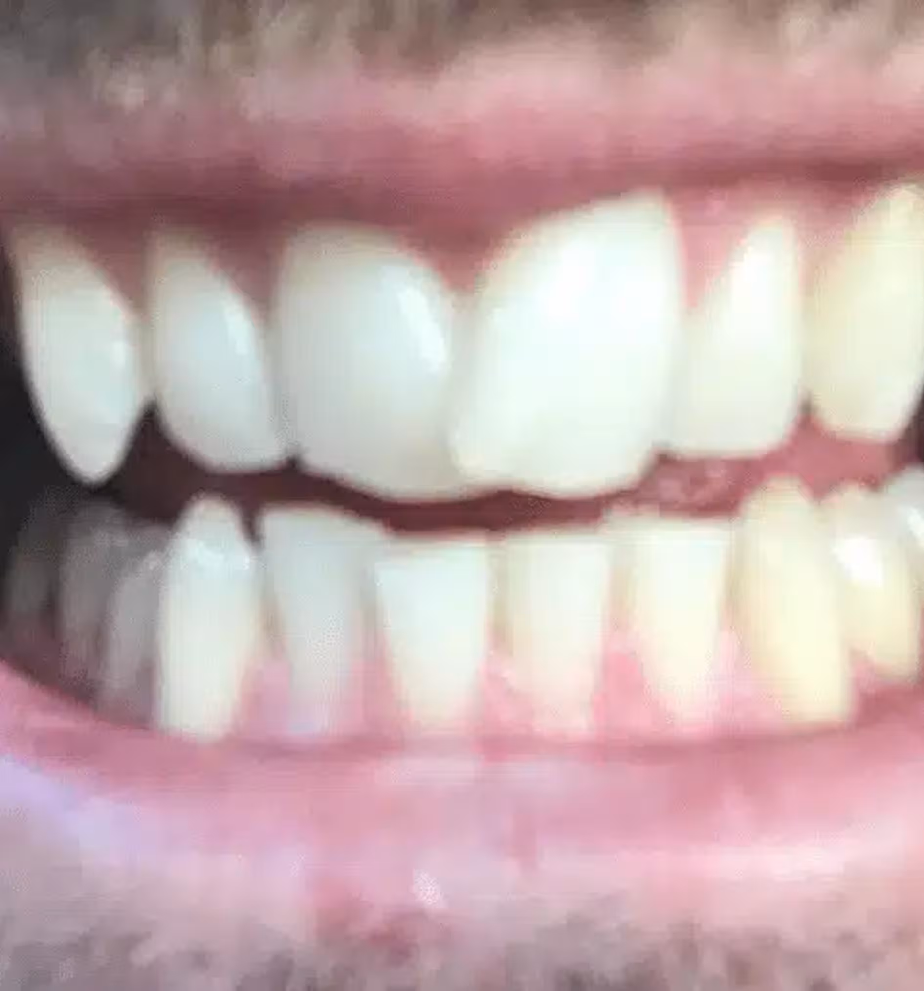 Close-up of slightly misaligned upper and lower teeth with visible gums and lips.