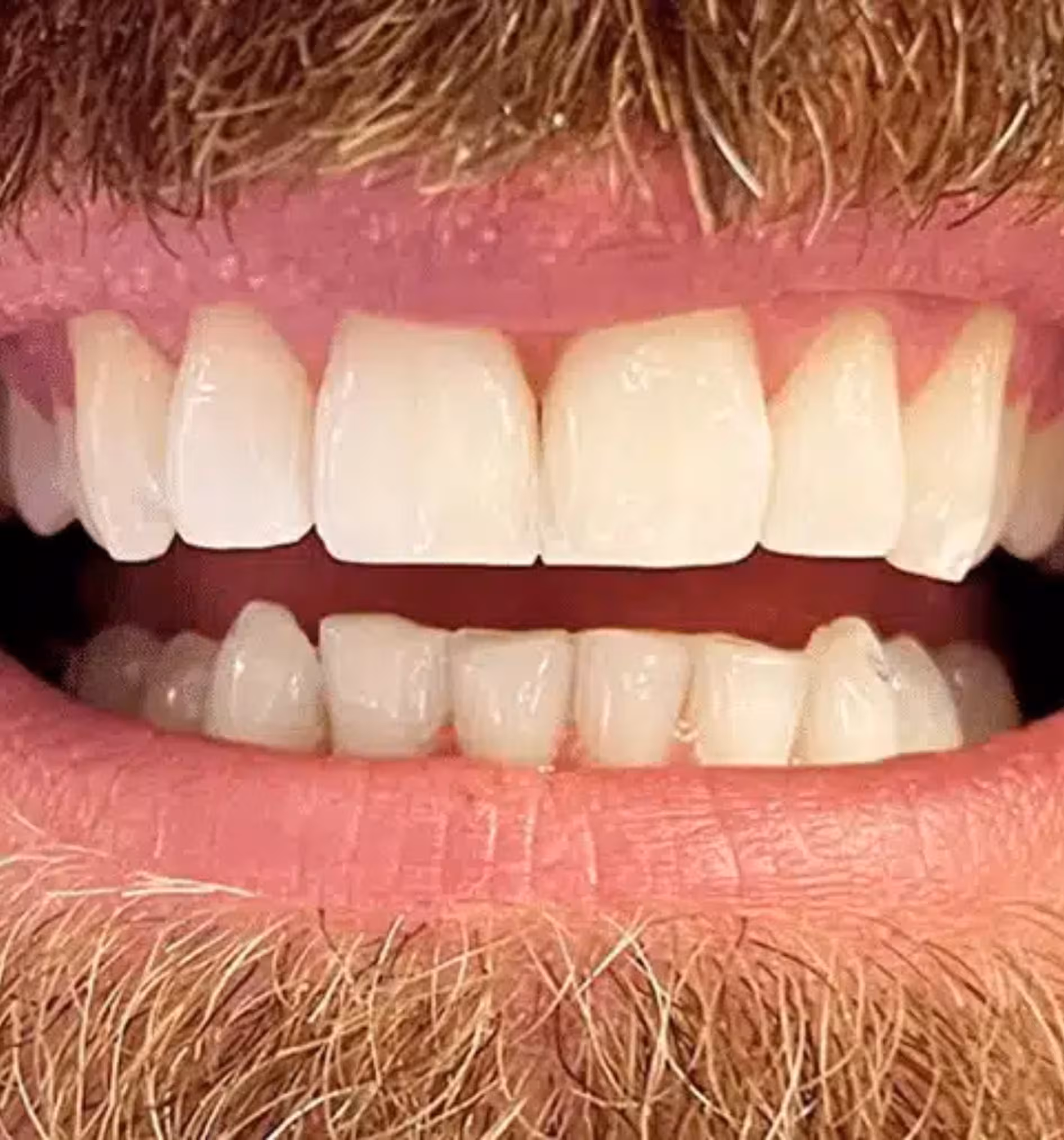 Close-up of a person's mouth showing upper and lower teeth with a mustache and beard.