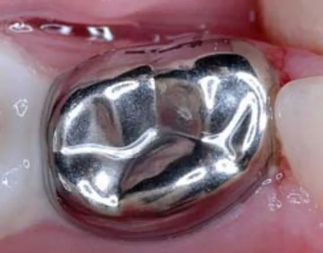Stainless steel crown fitted over a lower baby molar at Berala Dental
