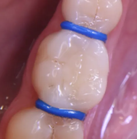 Blue separator bands placed between a child's molars before a stainless steel crown