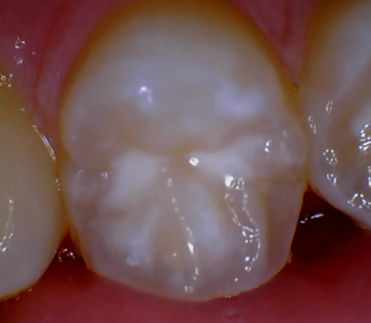 Fissure sealant protecting the grooves of a back tooth at Berala Dental
