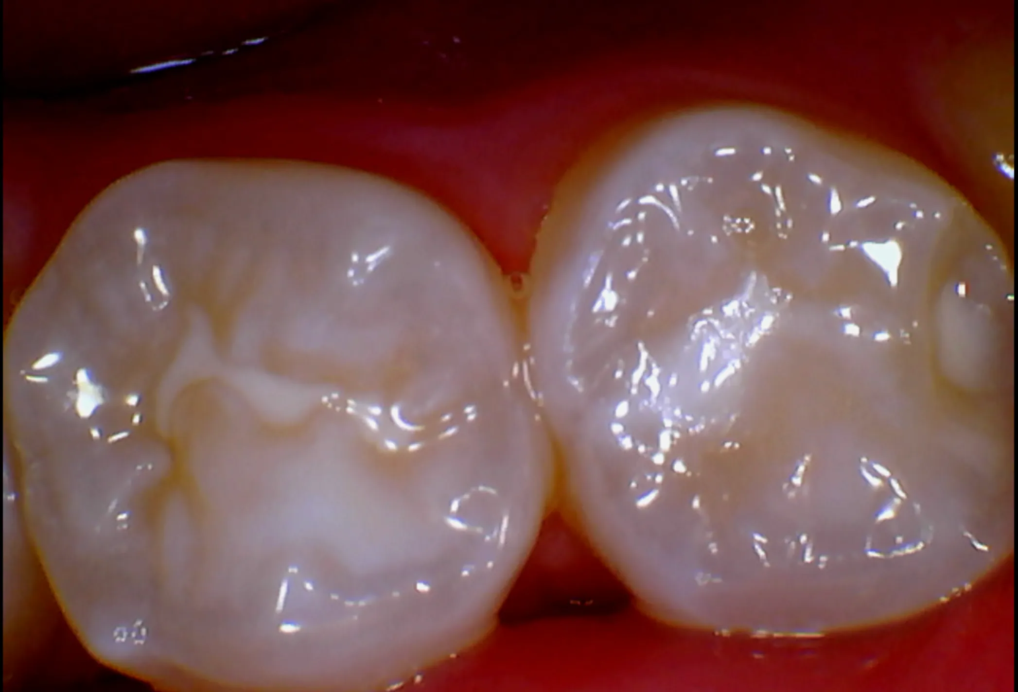 Fissure sealant protecting the grooves of a back tooth at Berala Dental