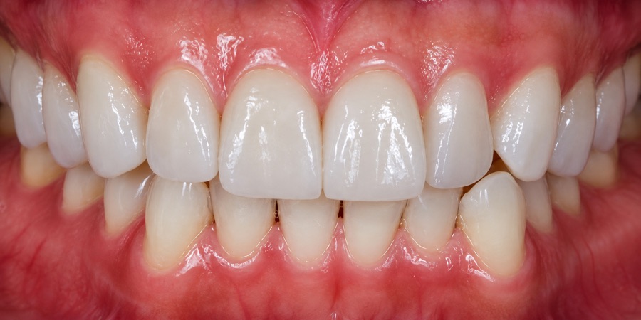 Healthy gums: firm, pale pink tissue sitting tightly against the teeth with no swelling or bleeding at the gumline.