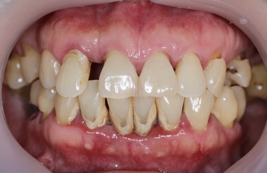 Periodontal disease: gums have receded well down the roots, heavy hardened build-up is visible, gaps have opened between the teeth and one front tooth has drifted out of line.