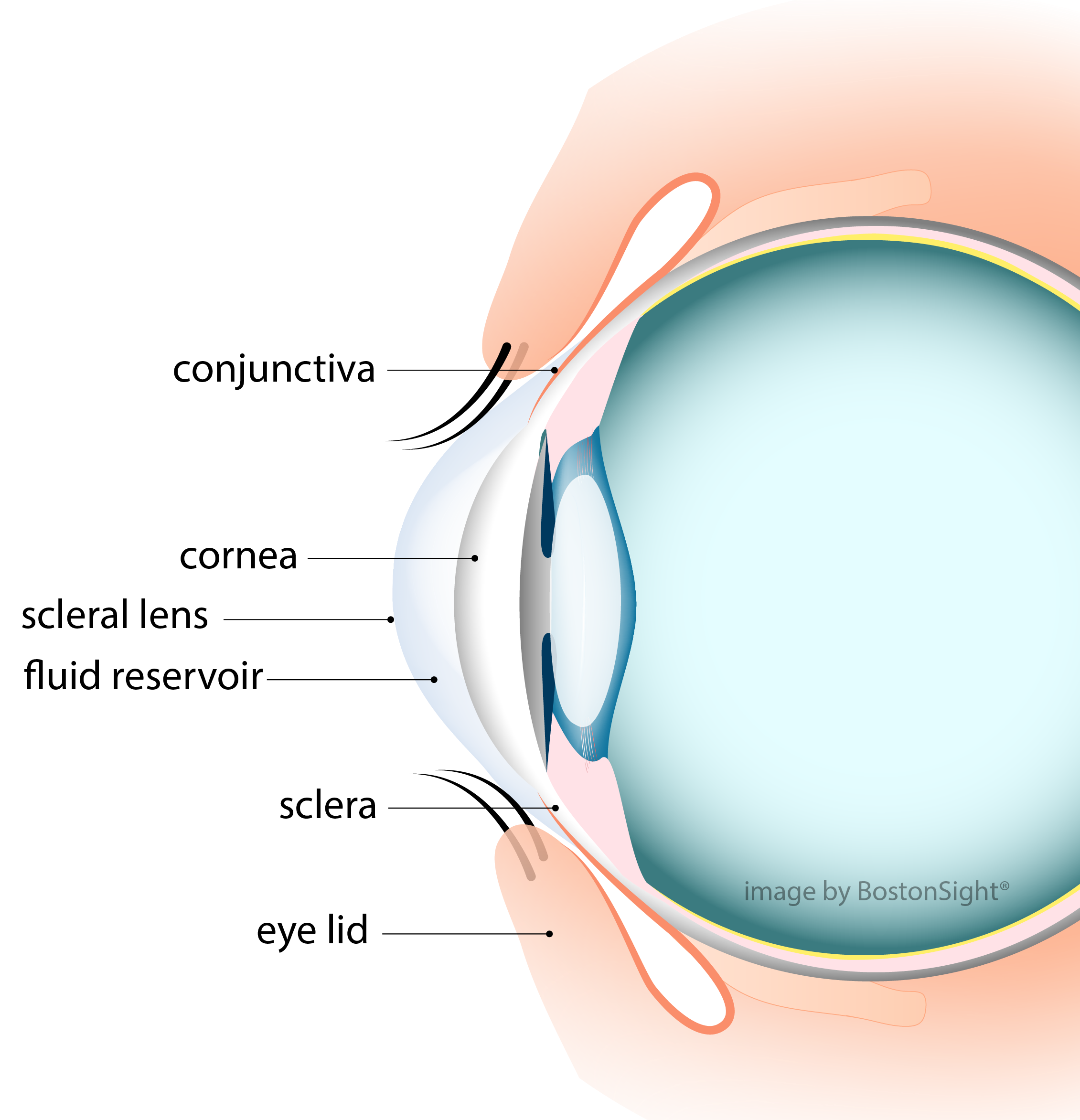 Scleral lens for keratoconus and irregular cornea at Toronto Vision Therapy and Optometry