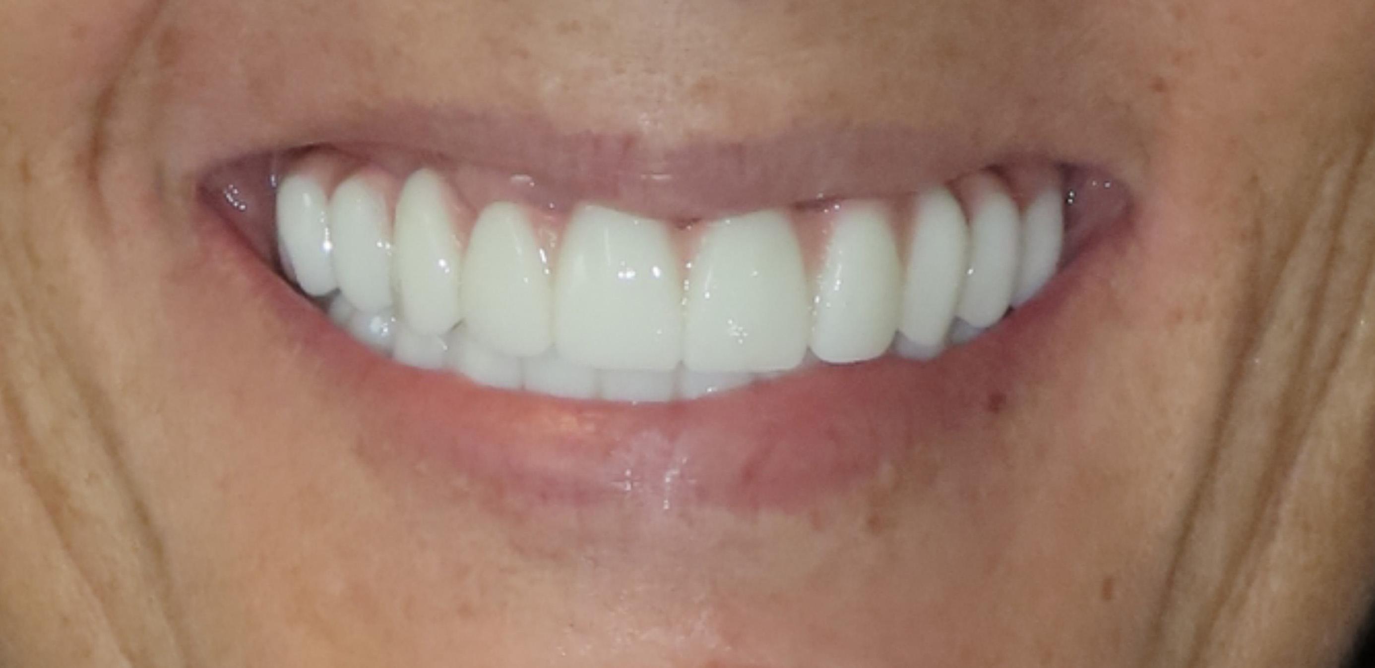 Close-up of a smiling mouth showing clean, evenly spaced white teeth.