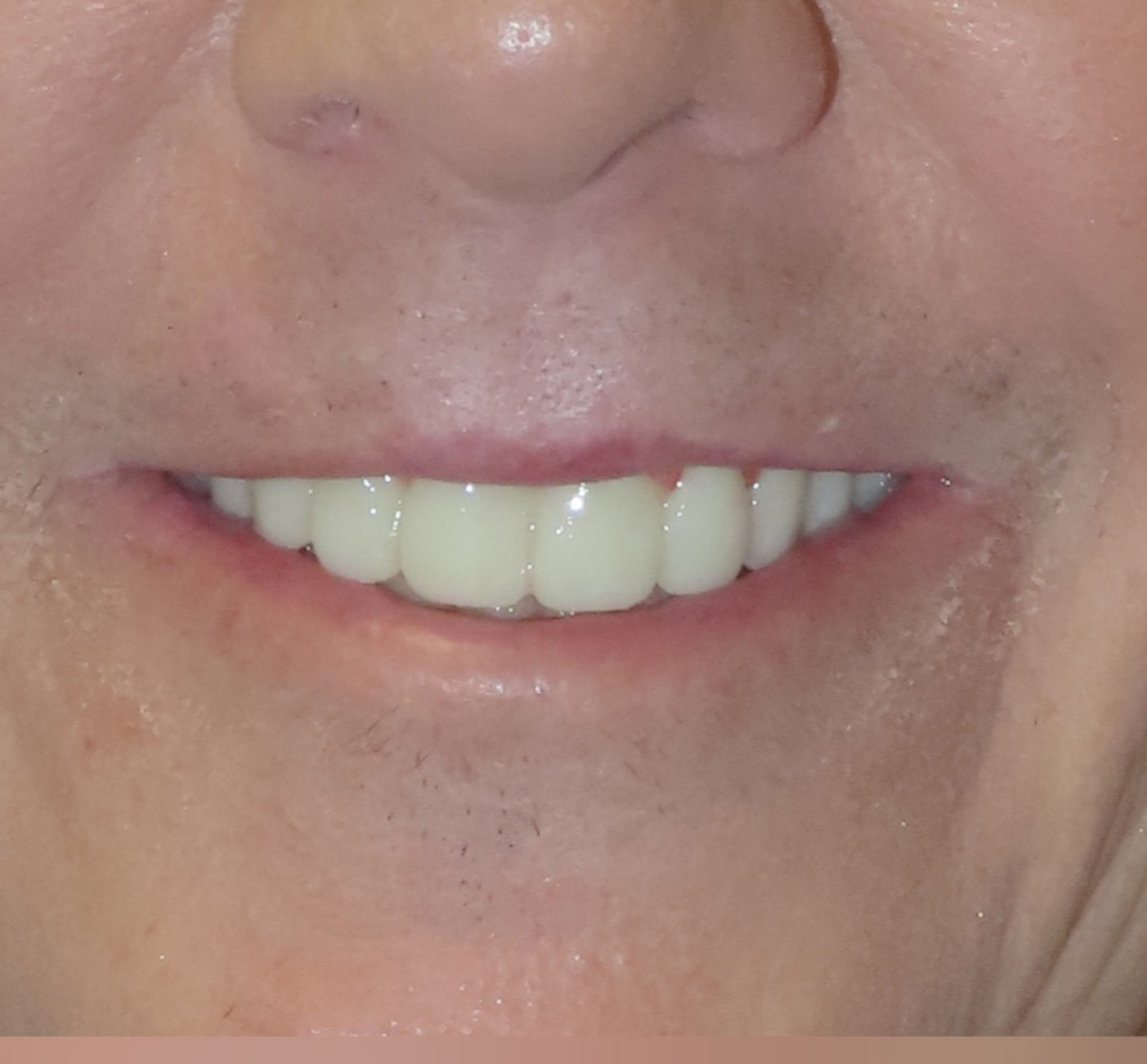 Close-up of a person's lower face showing a smile with white, evenly aligned teeth and light facial stubble.