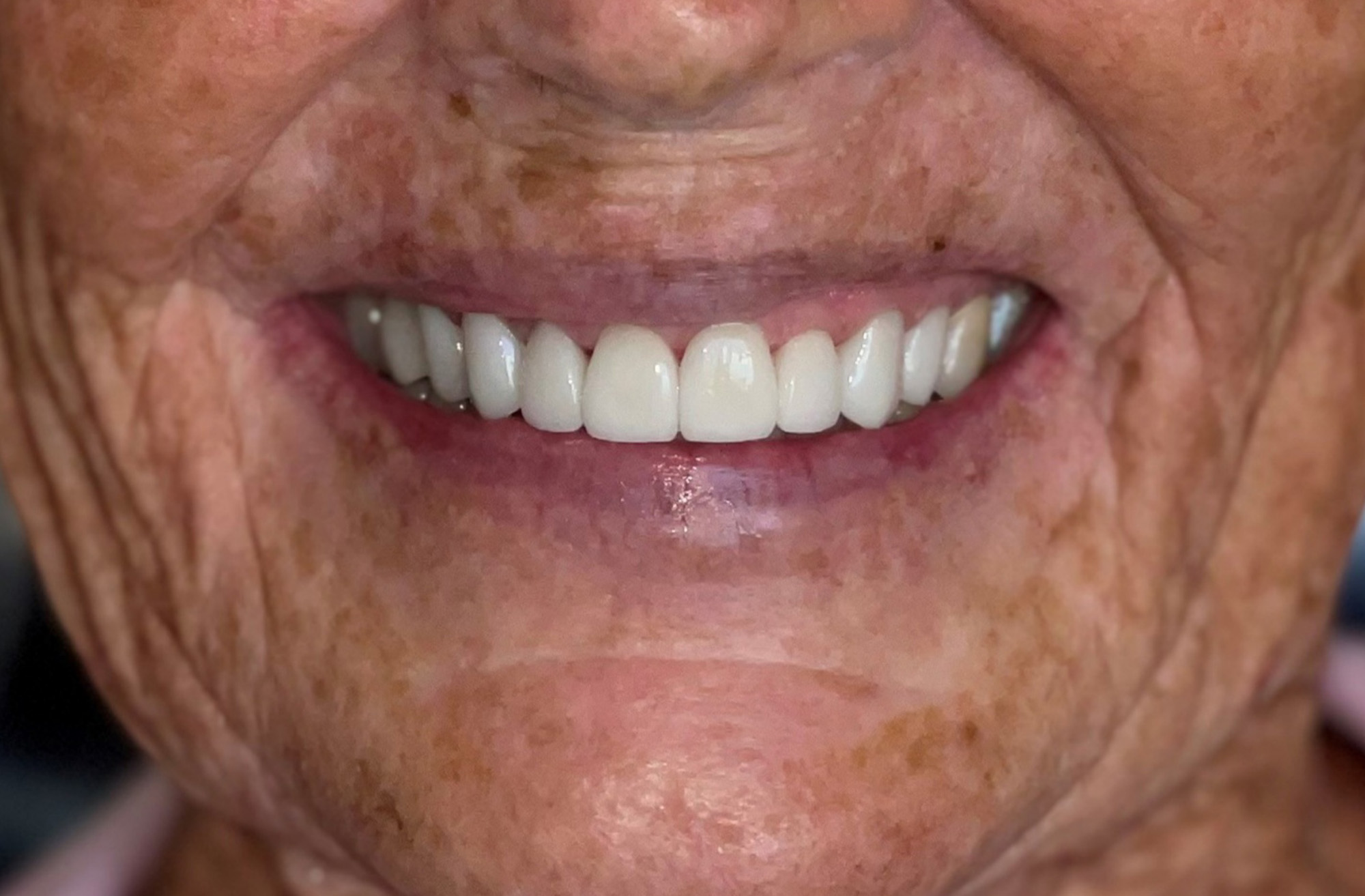 Close-up of a smiling older person's mouth showing white, well-aligned teeth and textured skin with age spots and wrinkles.