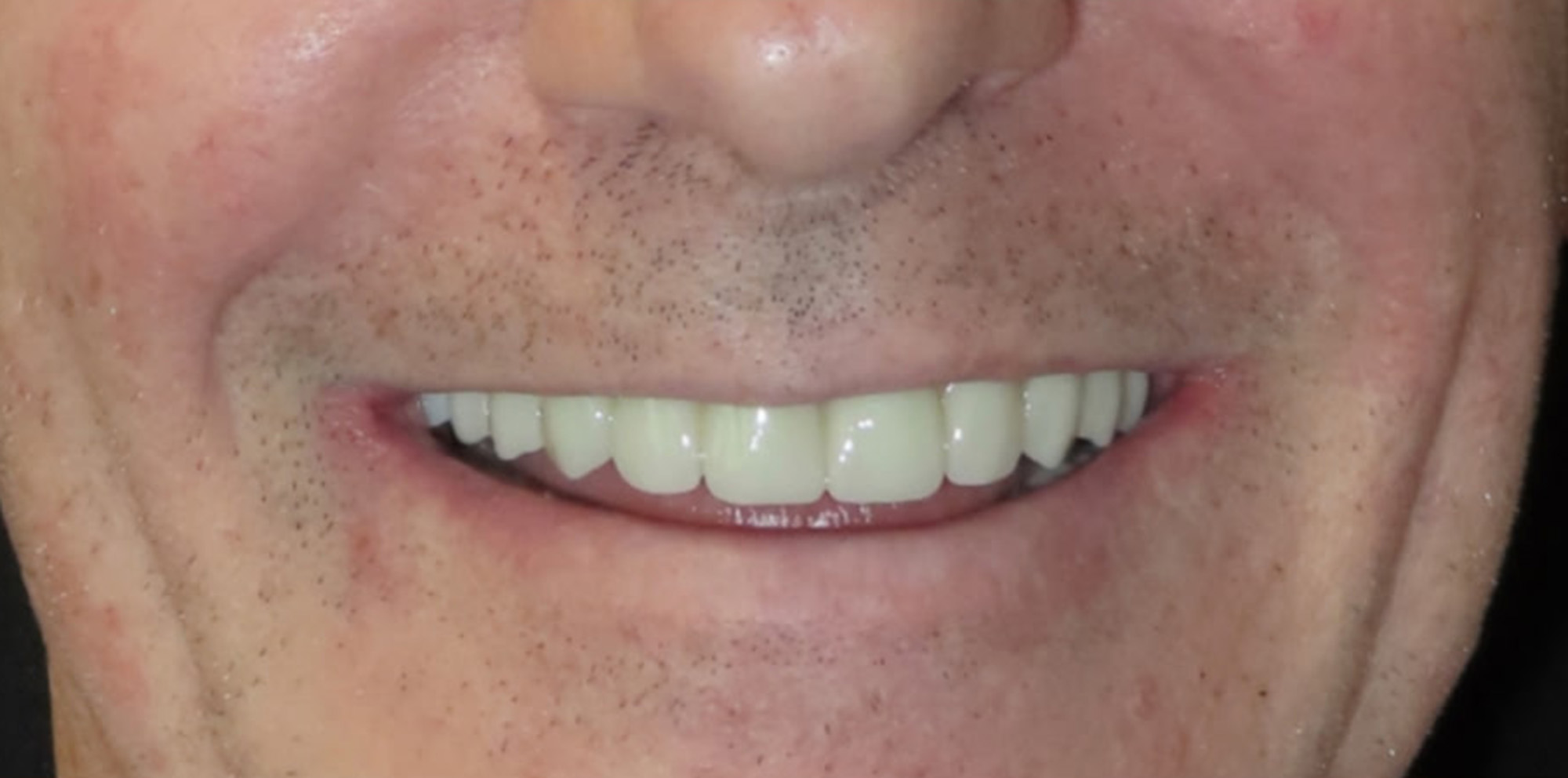 Close-up of a man's mouth showing a smile with white teeth and facial stubble.