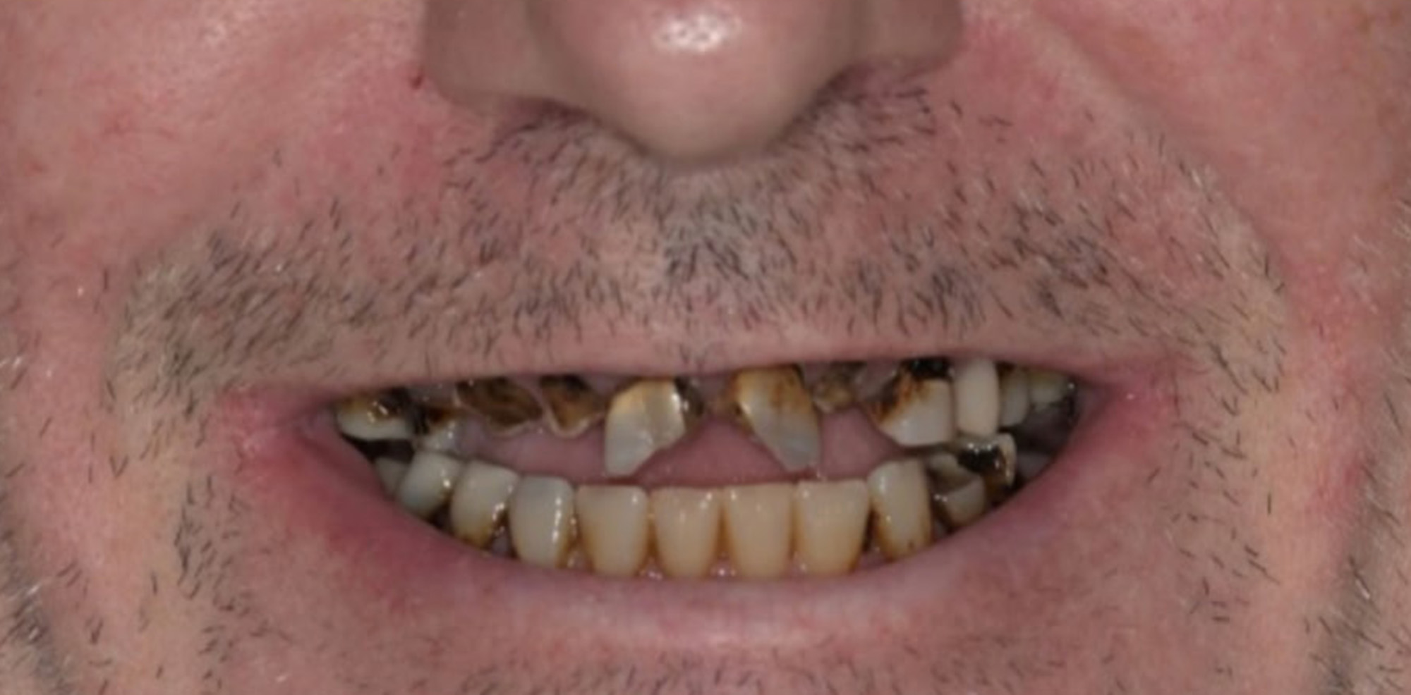 Close-up of a man's mouth showing severely decayed and discolored upper teeth and stained lower teeth.