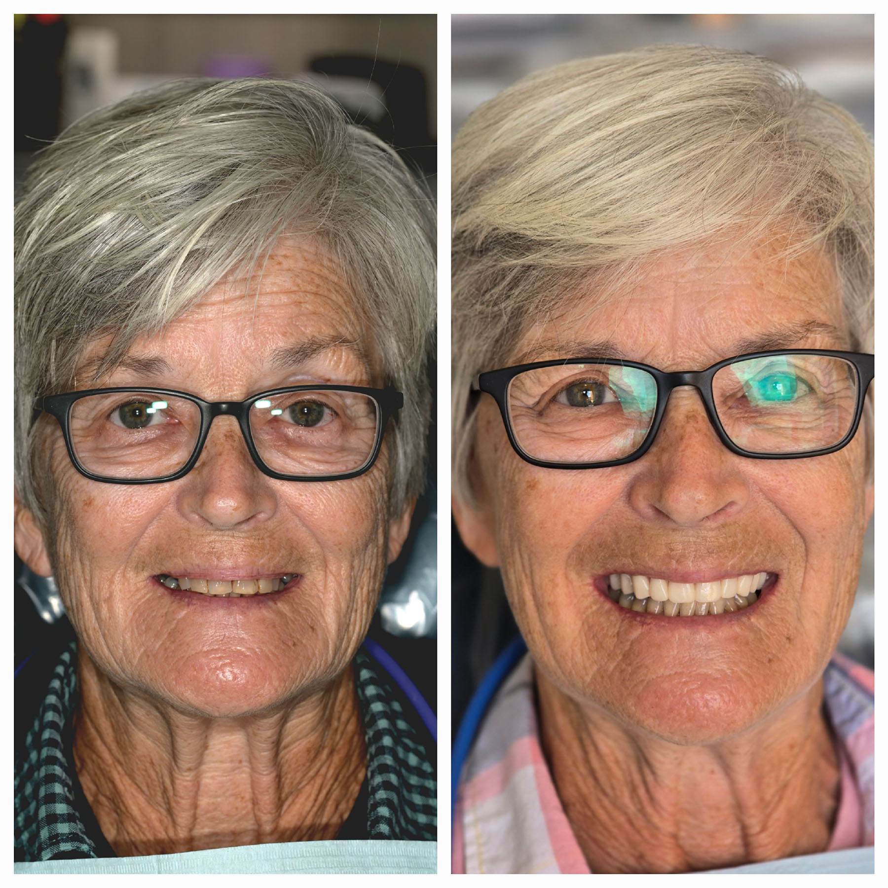 Side-by-side close-up portraits of an older woman with gray hair and glasses, showing a neutral expression on the left and a bright smile revealing teeth on the right.