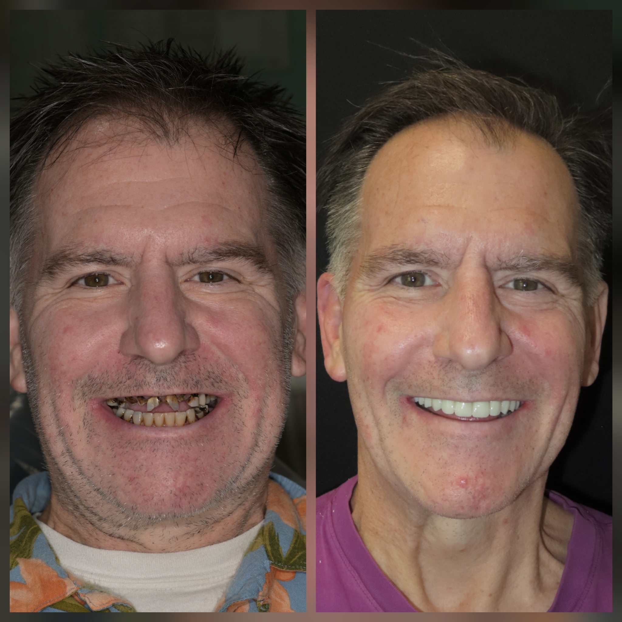 Side-by-side comparison of a middle-aged man before and after dental restoration showing damaged teeth and a bright, full smile respectively.