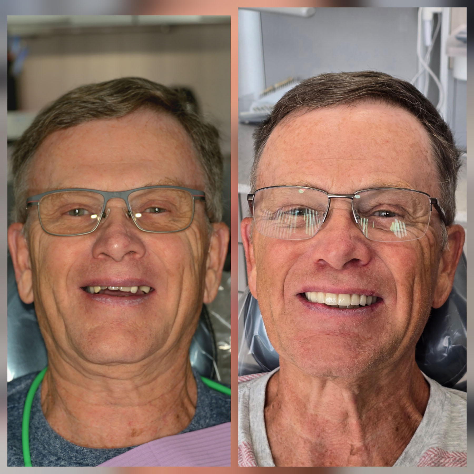 Before and after close-up photos of a senior man smiling, showing dental improvement with missing and then restored teeth.