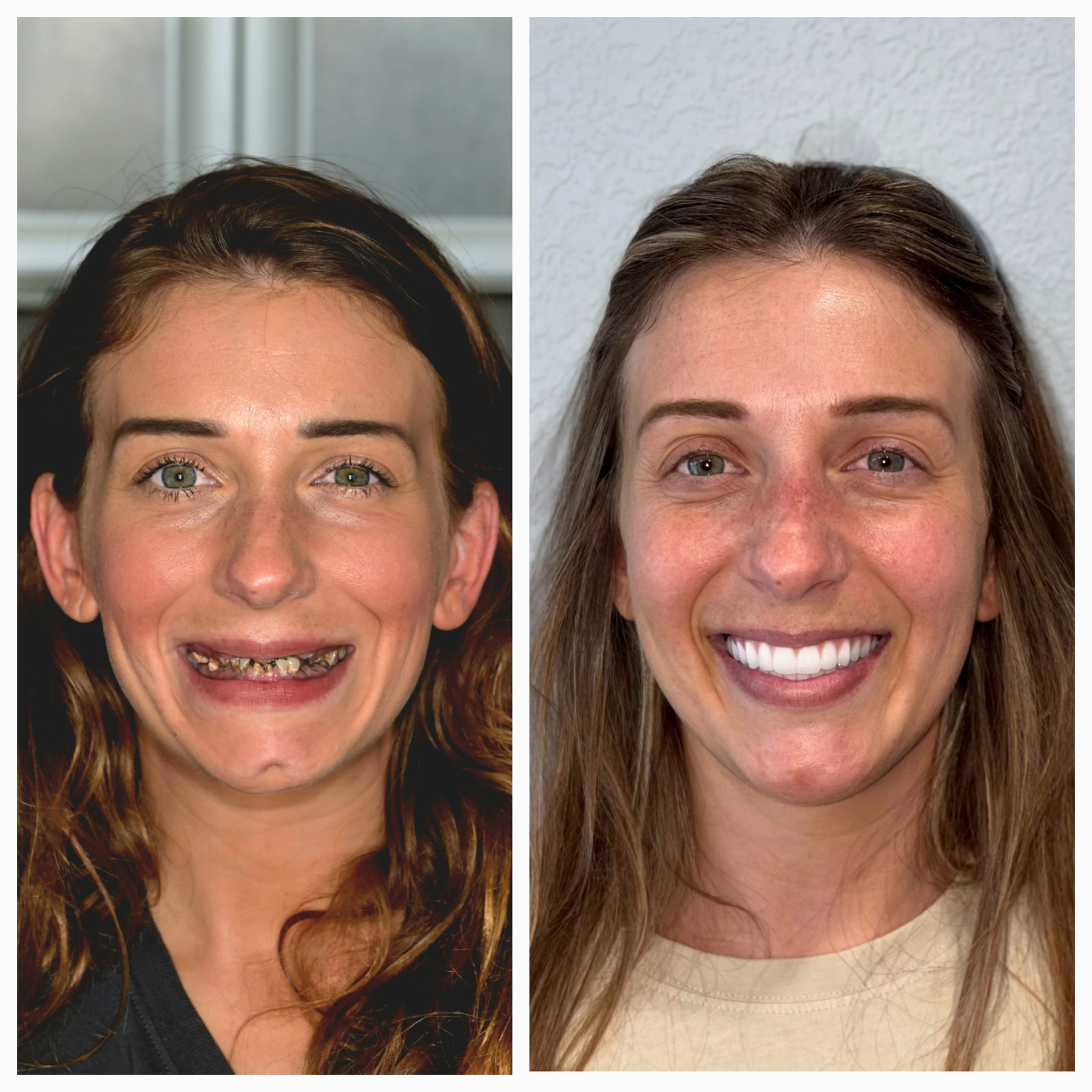 Side-by-side before and after photos of a woman showing dental restoration with bright white teeth.