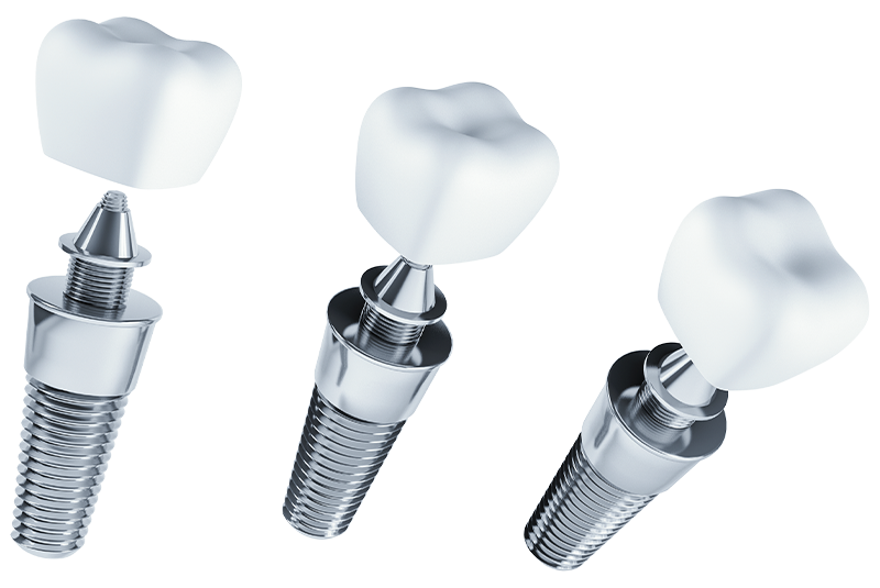 implants