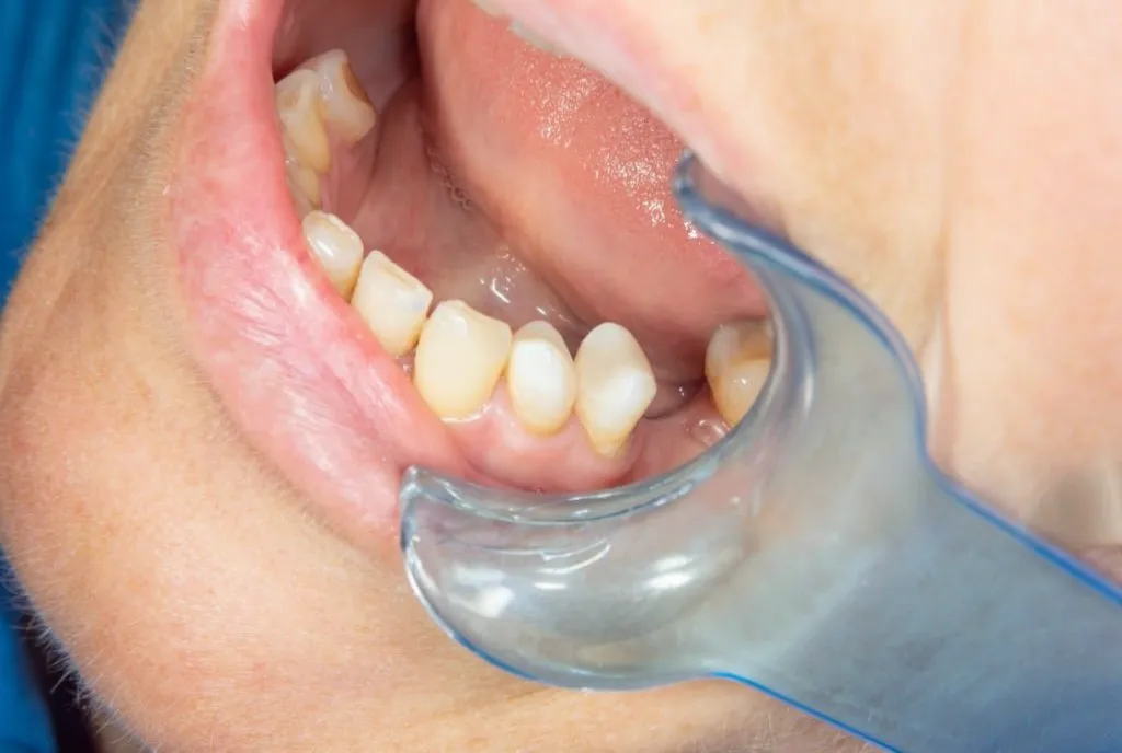Mouth being opened for orthodontic expansion treatment