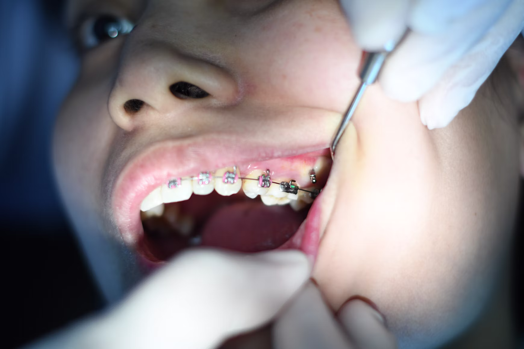 Patient with braces opening mouth during orthodontic treatment