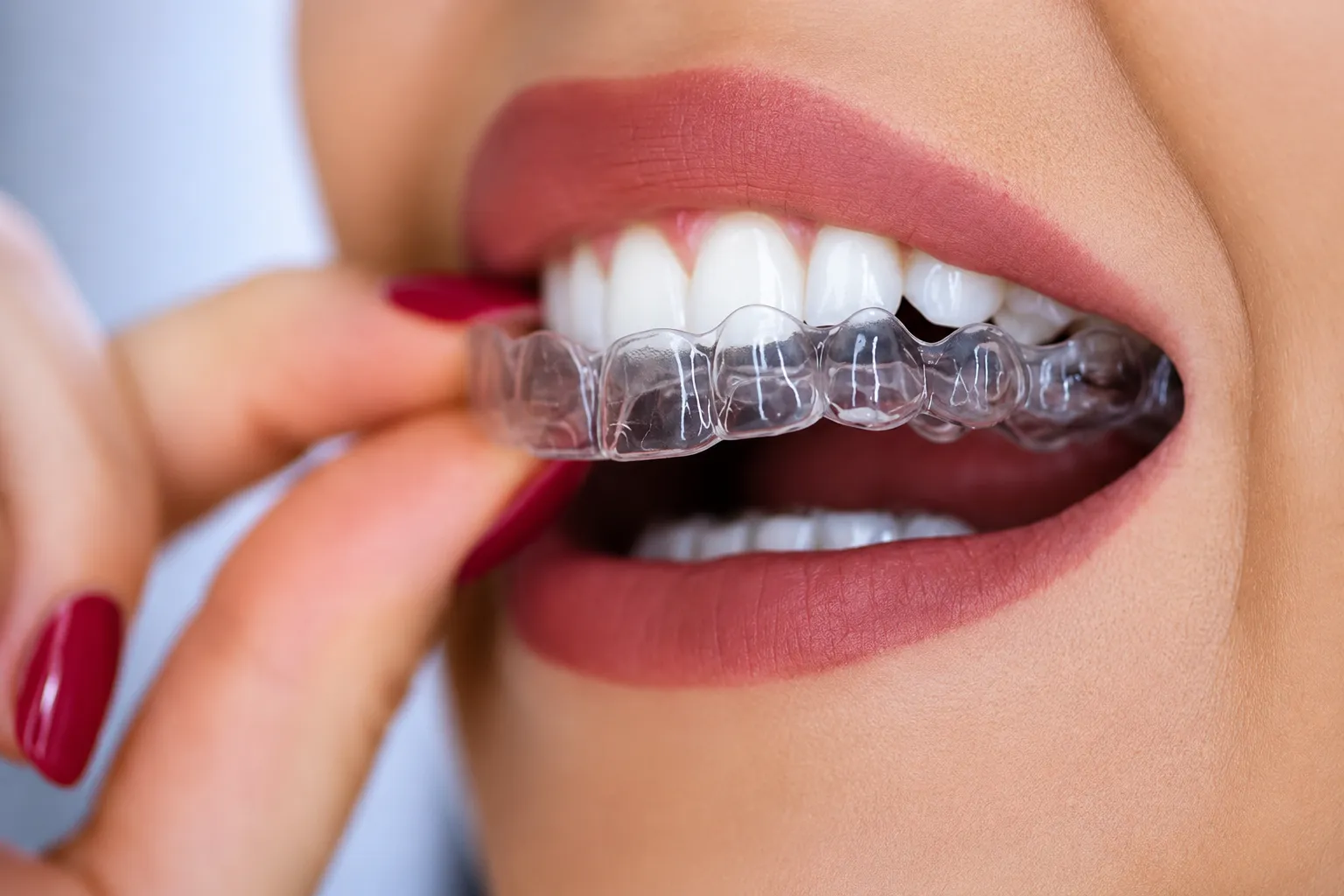 Patient placing a clear Invisalign aligner on her teeth