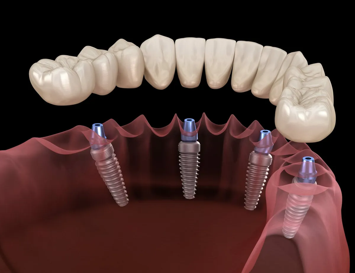 Імплантація зубів All-on-4 / All-on-6