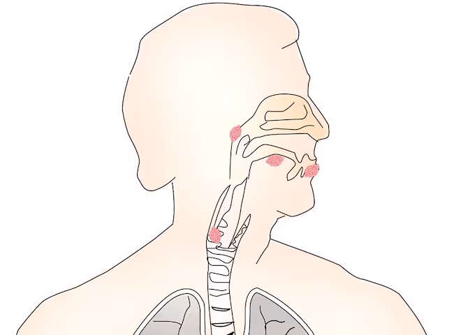 All about apraxia of speech