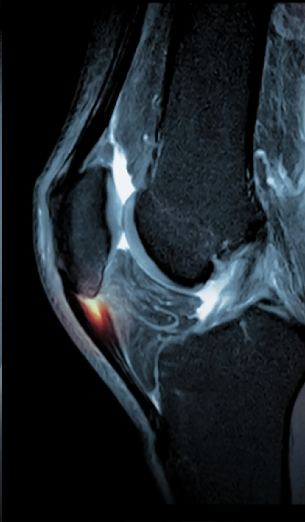 Röntgen- / MRT-Bild Patellaspitzensyndrom