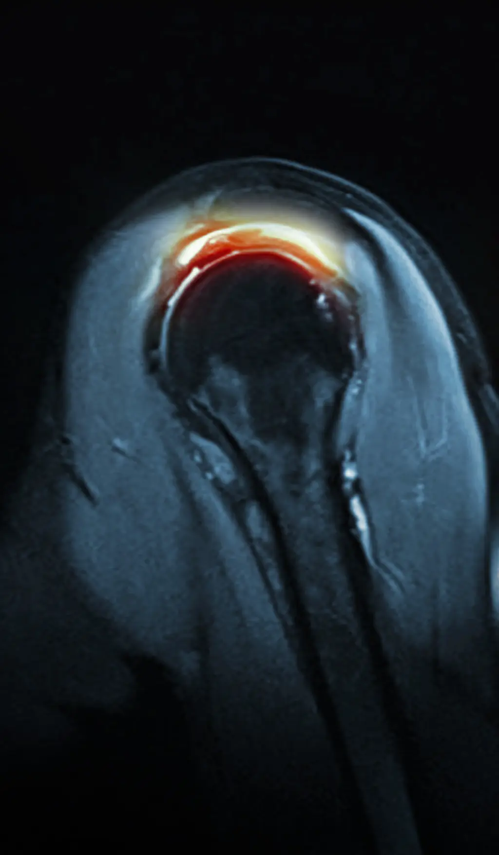 Röntgenaufnahme eines Impingement-Syndroms