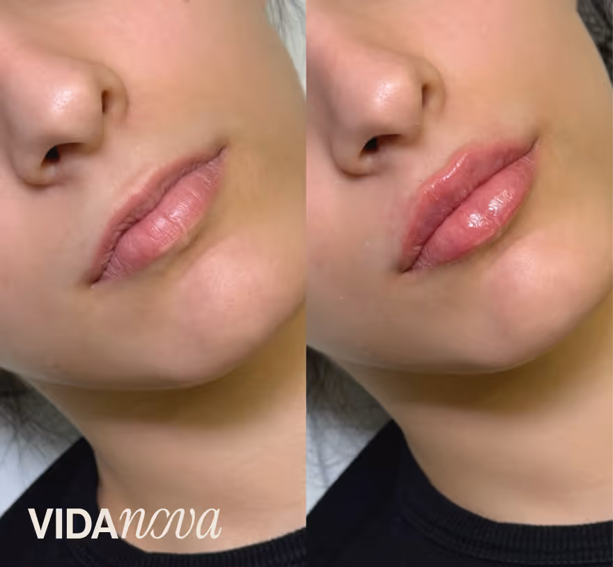 Prikaz pre i posle ulepšavanja usana sa diskretnim povećanjem i sjajem.