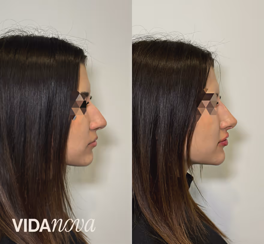 Profil žene pre i posle estetske korekcije nosa na beloj pozadini.