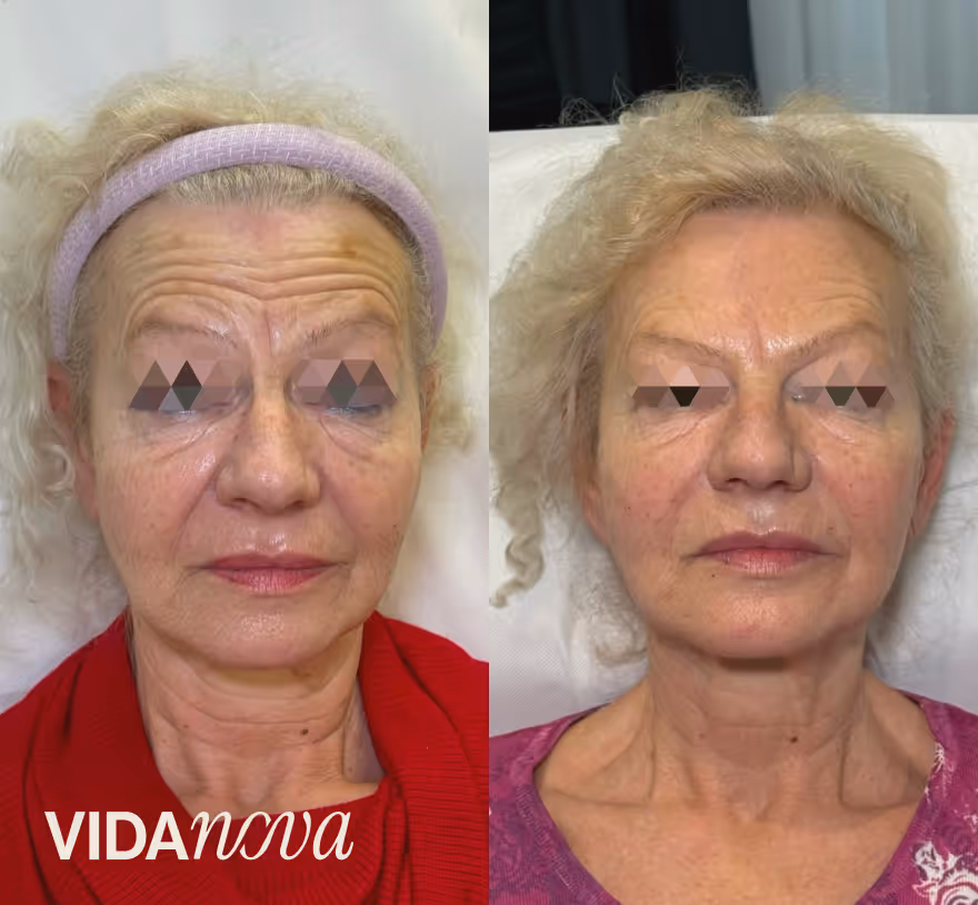 Pre- and post-treatment faces of an older woman showing reduced wrinkles and smoother skin.