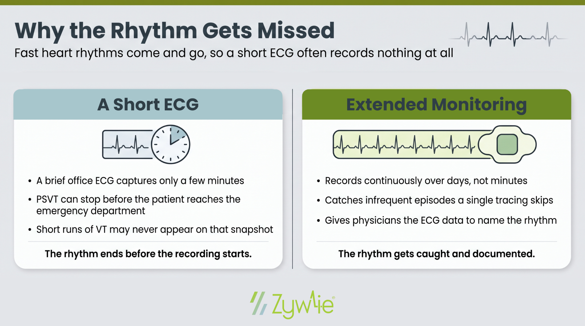 Why intermittent rhythms get missed: a short office ECG captures only minutes and can end before the rhythm starts, while extended monitoring records continuously over days to catch and document infrequent episodes.